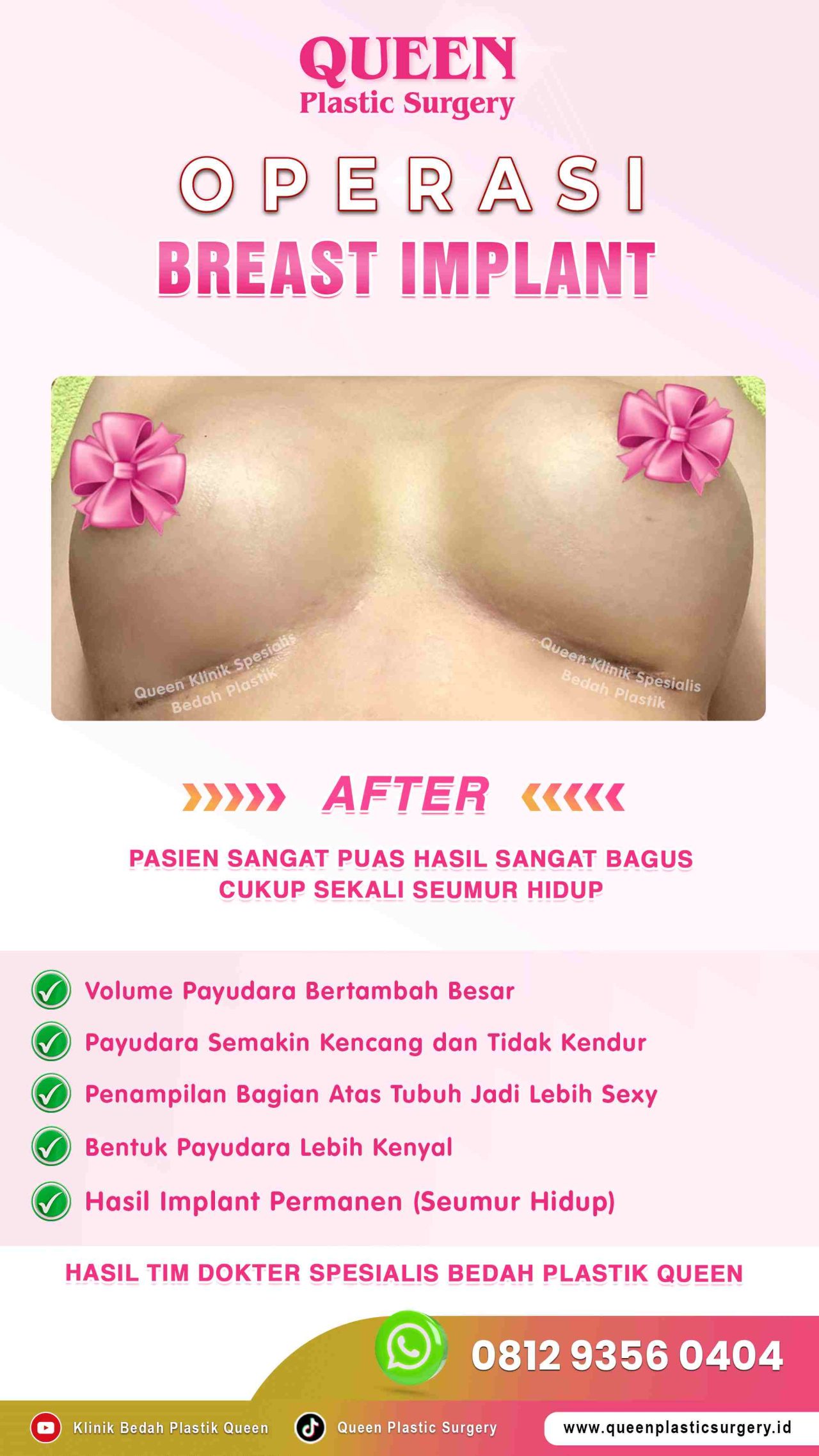 AFTER-Breast-Implant-Hasil-Memuaskan-009 (1)-fotor-2024012916949
