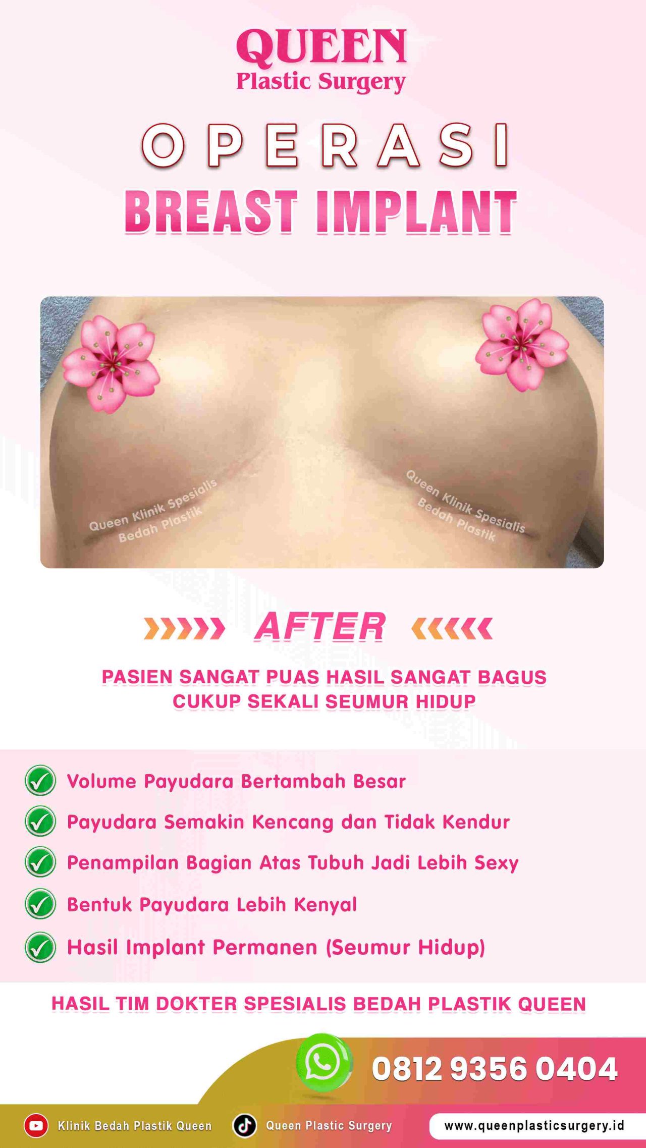 AFTER-Breast-Implant-Hasil-Memuaskan-011 (1)-fotor-20240129164251