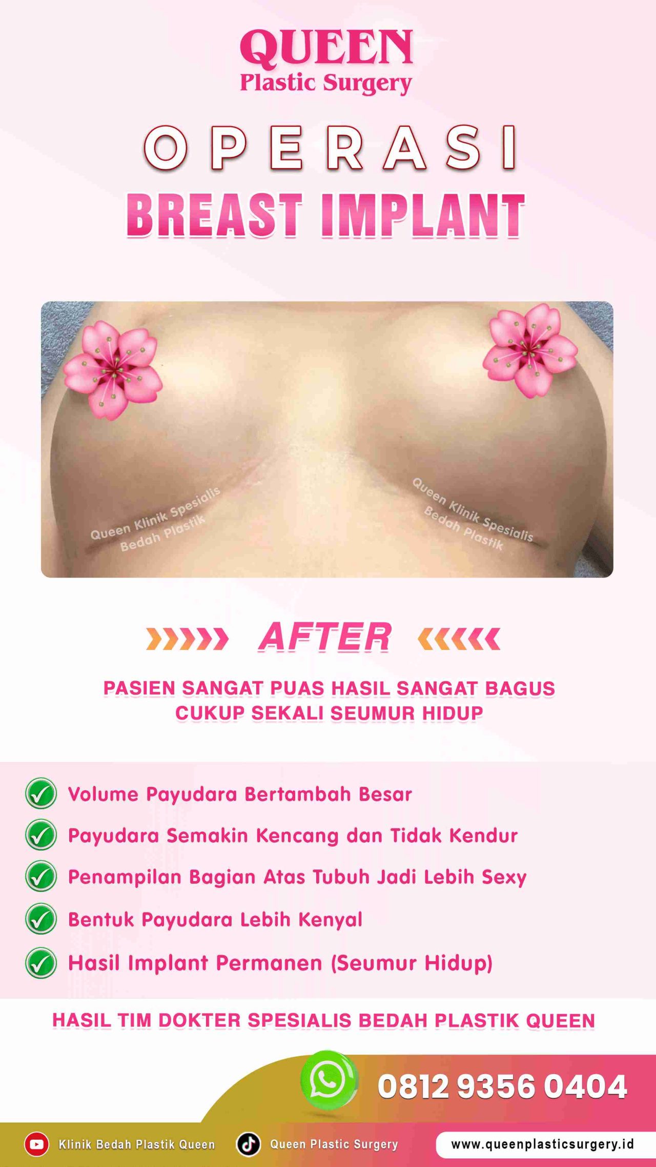 AFTER-Breast-Implant-Hasil-Memuaskan-011 (1)-fotor-20240129172440