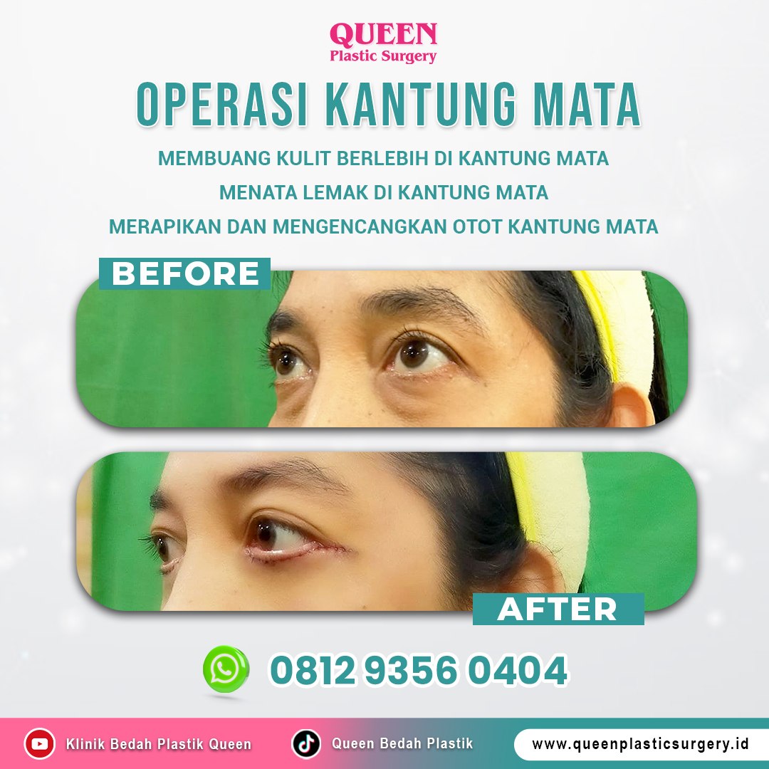 https://queenplasticsurgery.id/wp-content/uploads/2024/01/Before-After-Feed-Landing-Page-Web.jpg