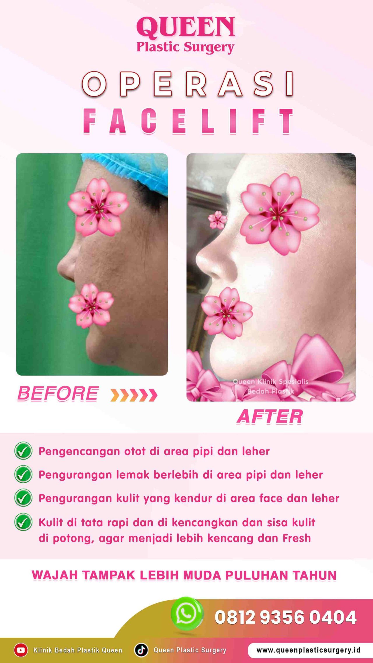 Hasil Face Surgery Queen Plastic Surgery, foto 13
