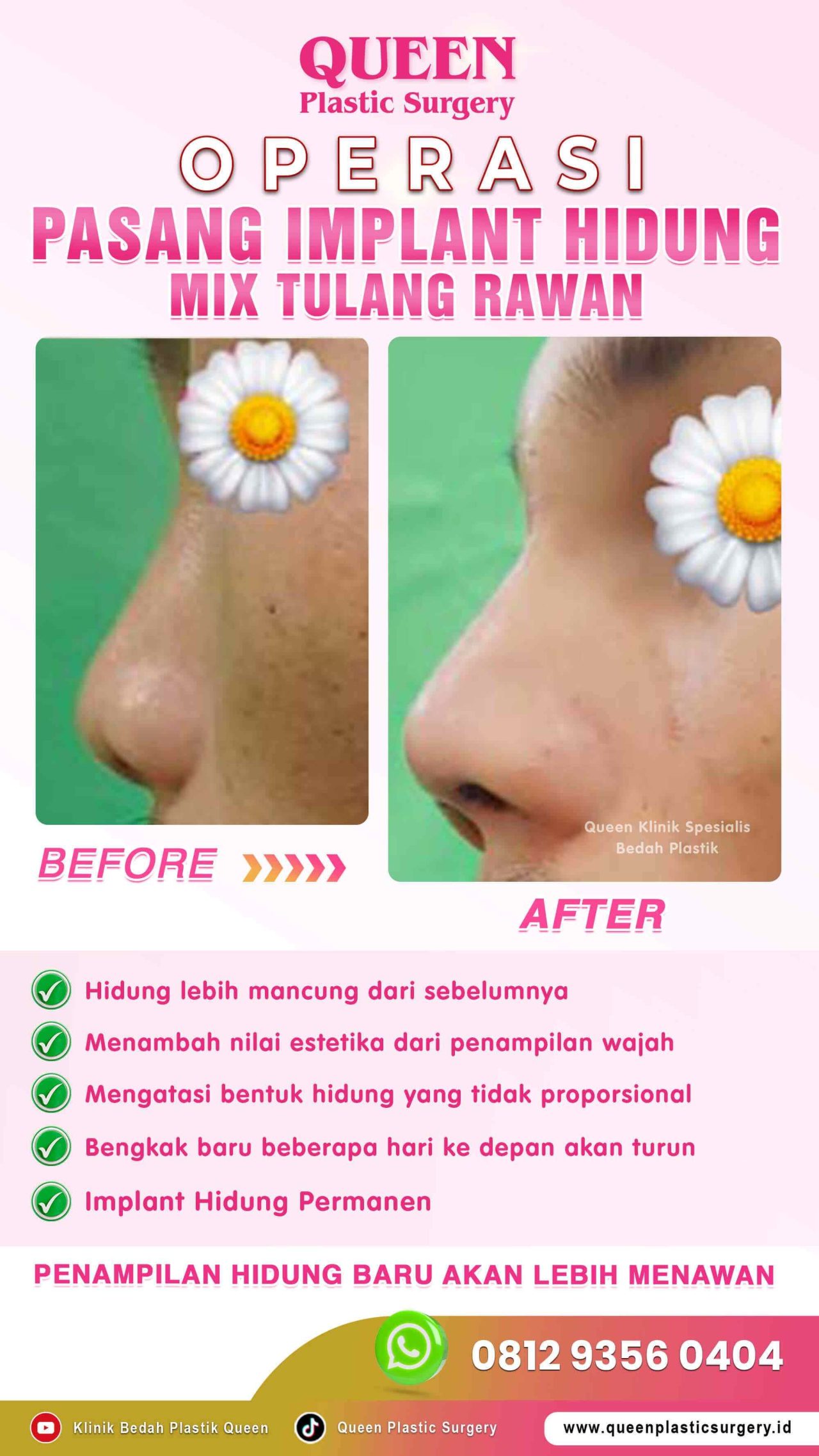 Before-After-Operasi-Hidung-Queen-001 (1) (1)-fotor-20240130125822