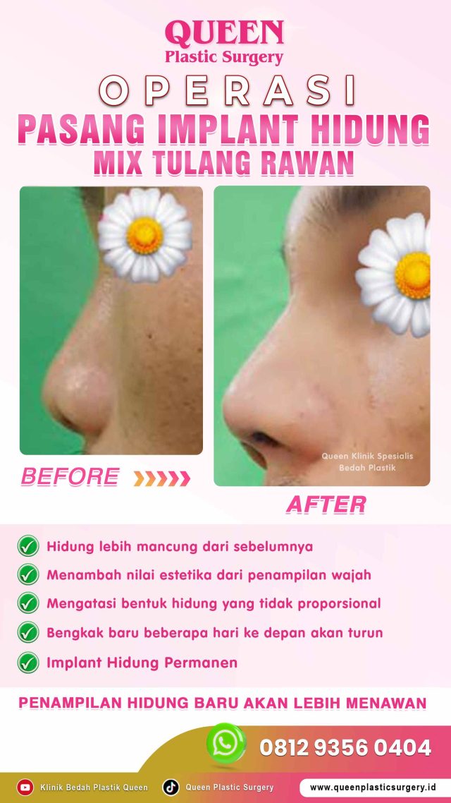 Jenis-jenis Operasi Hidung yang Tersedia di Queen Plastic Surgery