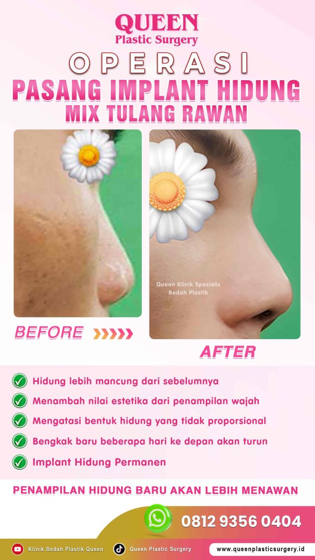 Mengapa Queen Plastic Surgery Menjadi Pilihan Utama untuk Operasi Hidung?