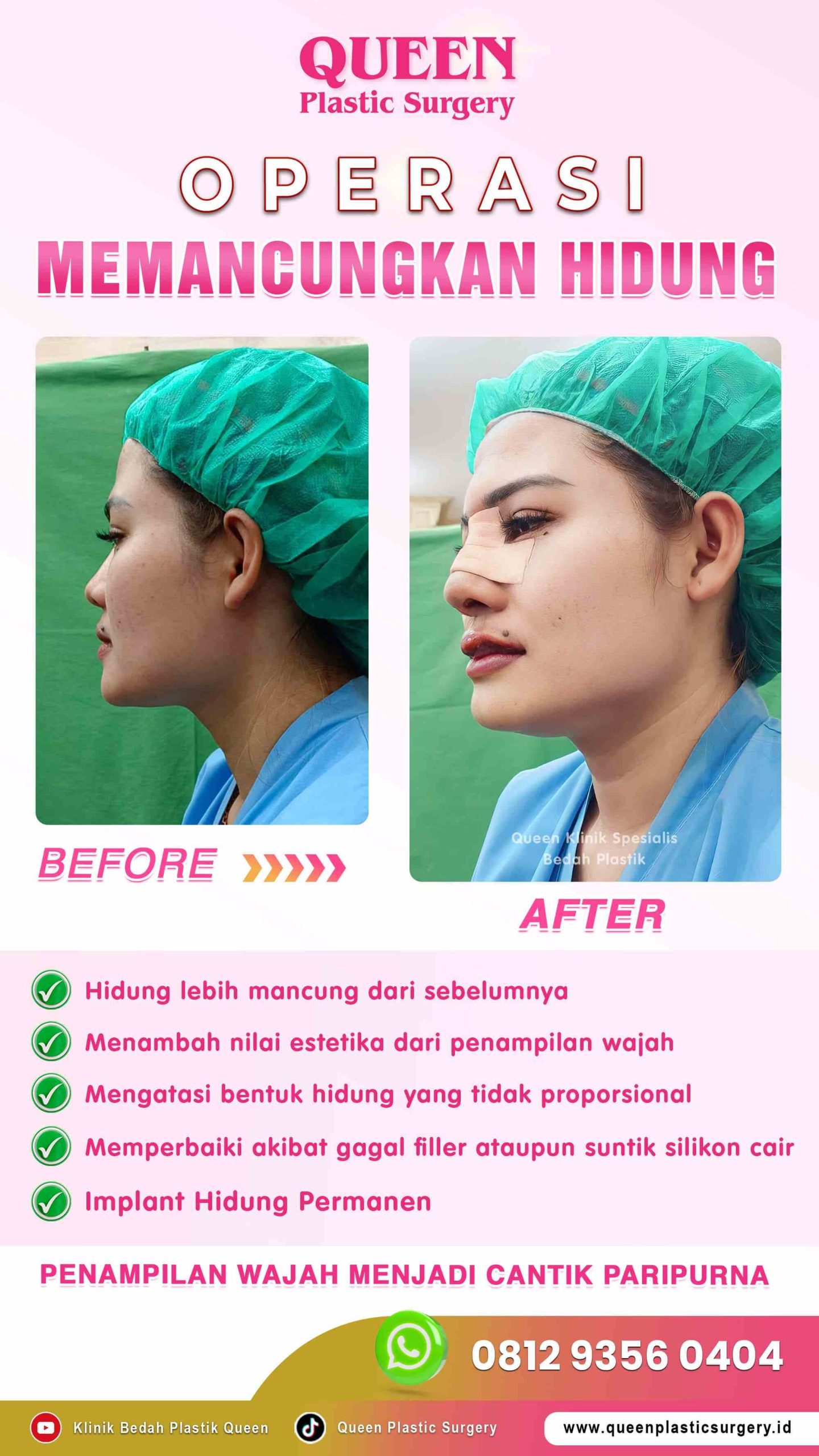 Before-After-Revisi-Hidung-Queen-001 (1)-fotor-20240130123946