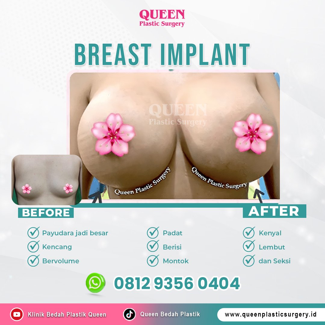 https://queenplasticsurgery.id/wp-content/uploads/2024/01/Breast-Implant-Feed-Landing-Page-Web-3.jpg