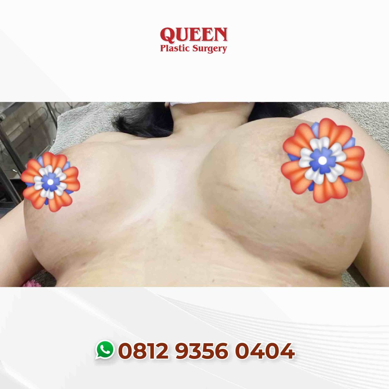 Hasil Breast Implant Queen Plastic Surgery, foto 26