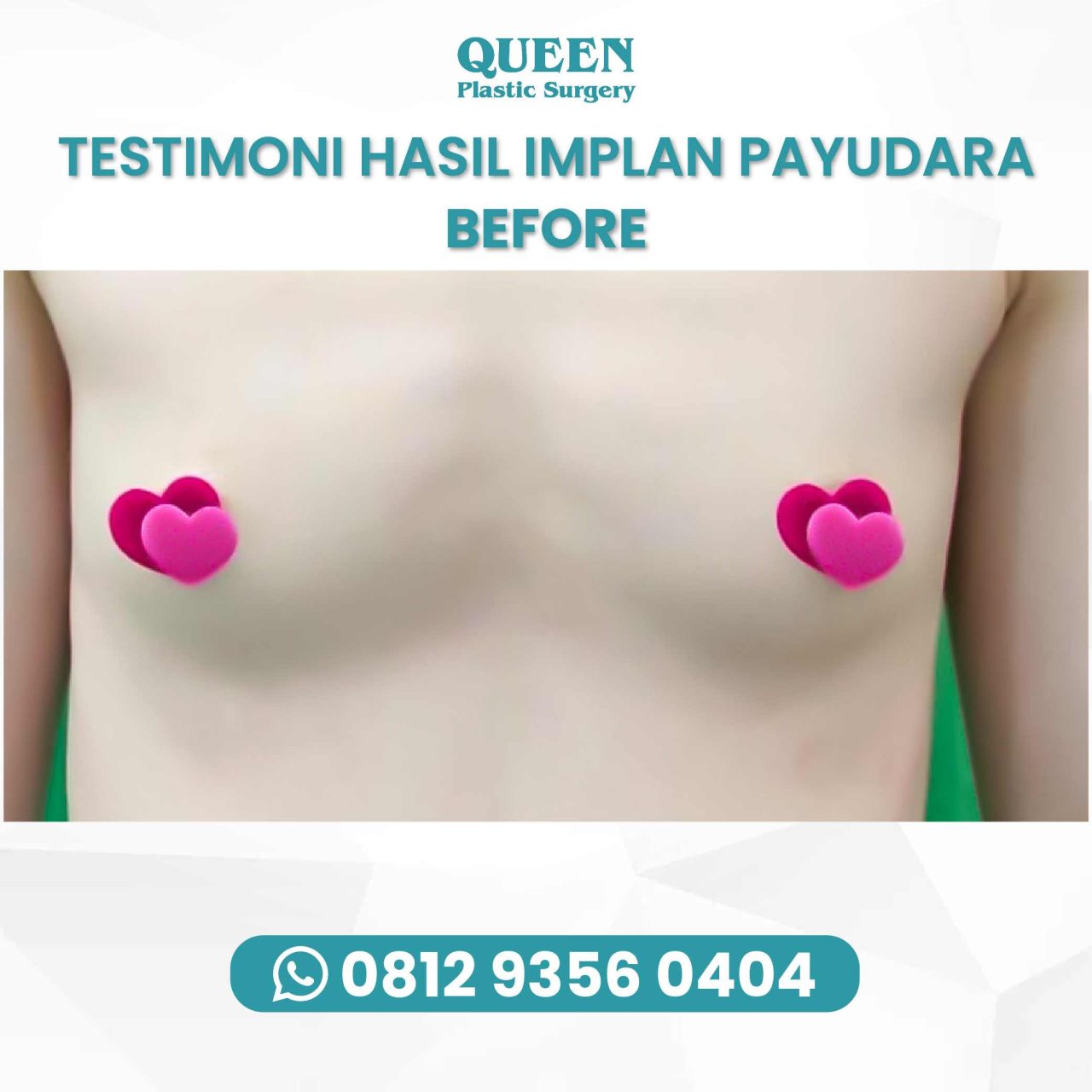 Hasil Breast Implant Queen Plastic Surgery, foto 29