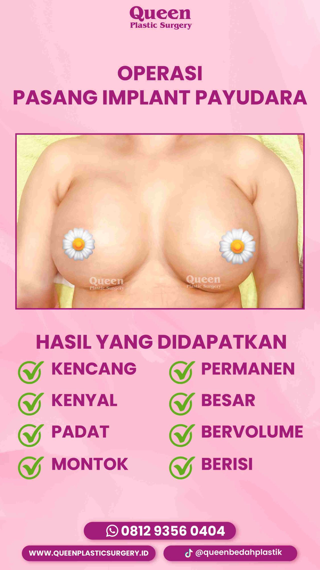 Hasil Breast Implant Queen Plastic Surgery, foto 32