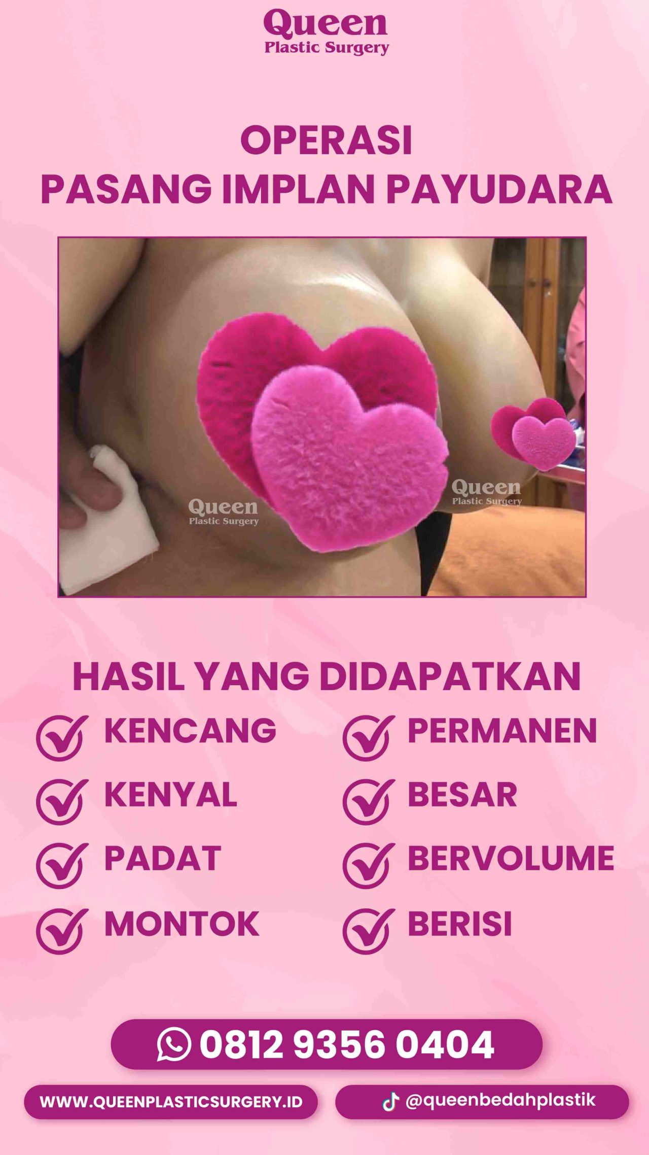 Hasil Breast Implant Queen Plastic Surgery, foto 10