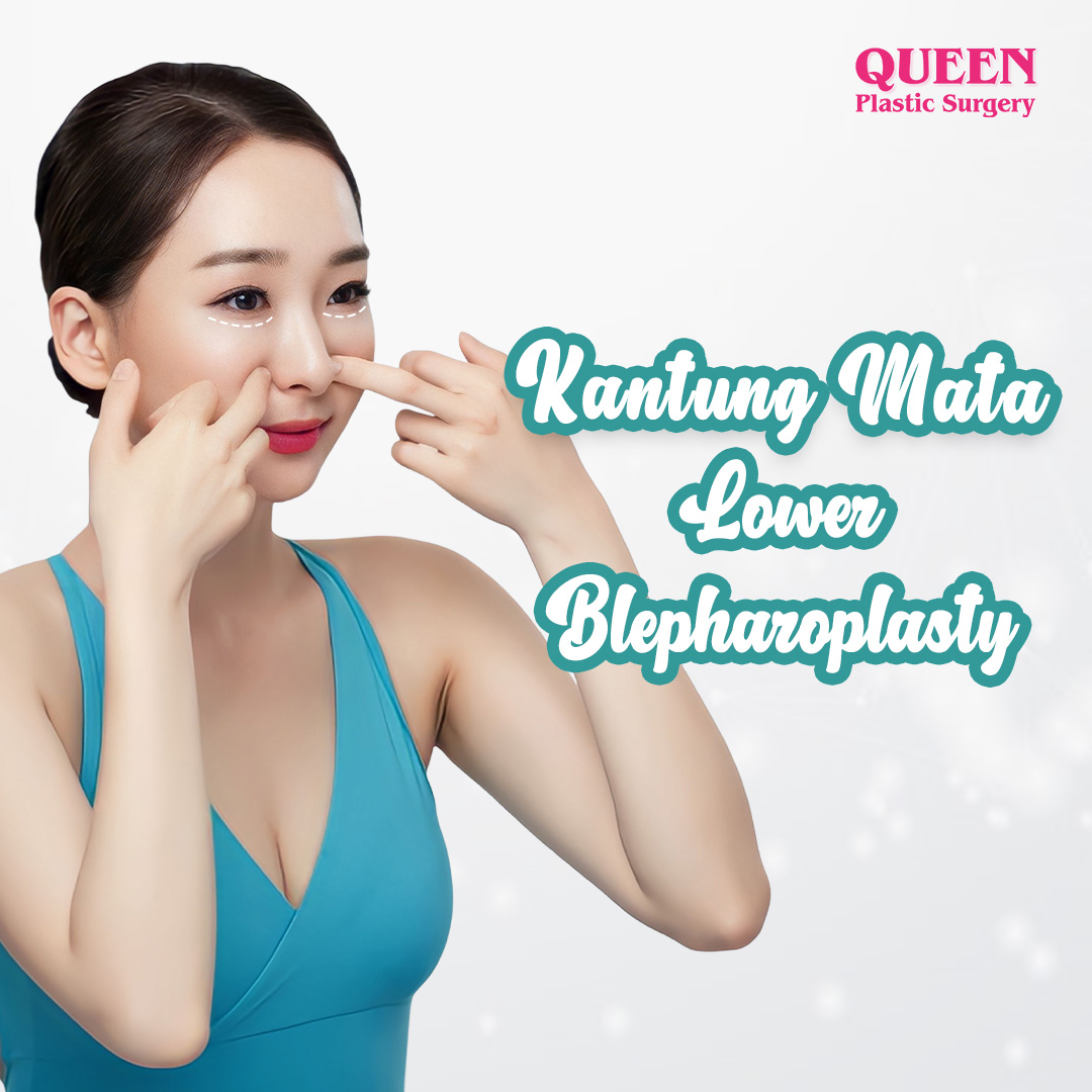 https://queenplasticsurgery.id/wp-content/uploads/2024/01/Kantung-Mata-Lower-Blepharoplasty.jpg