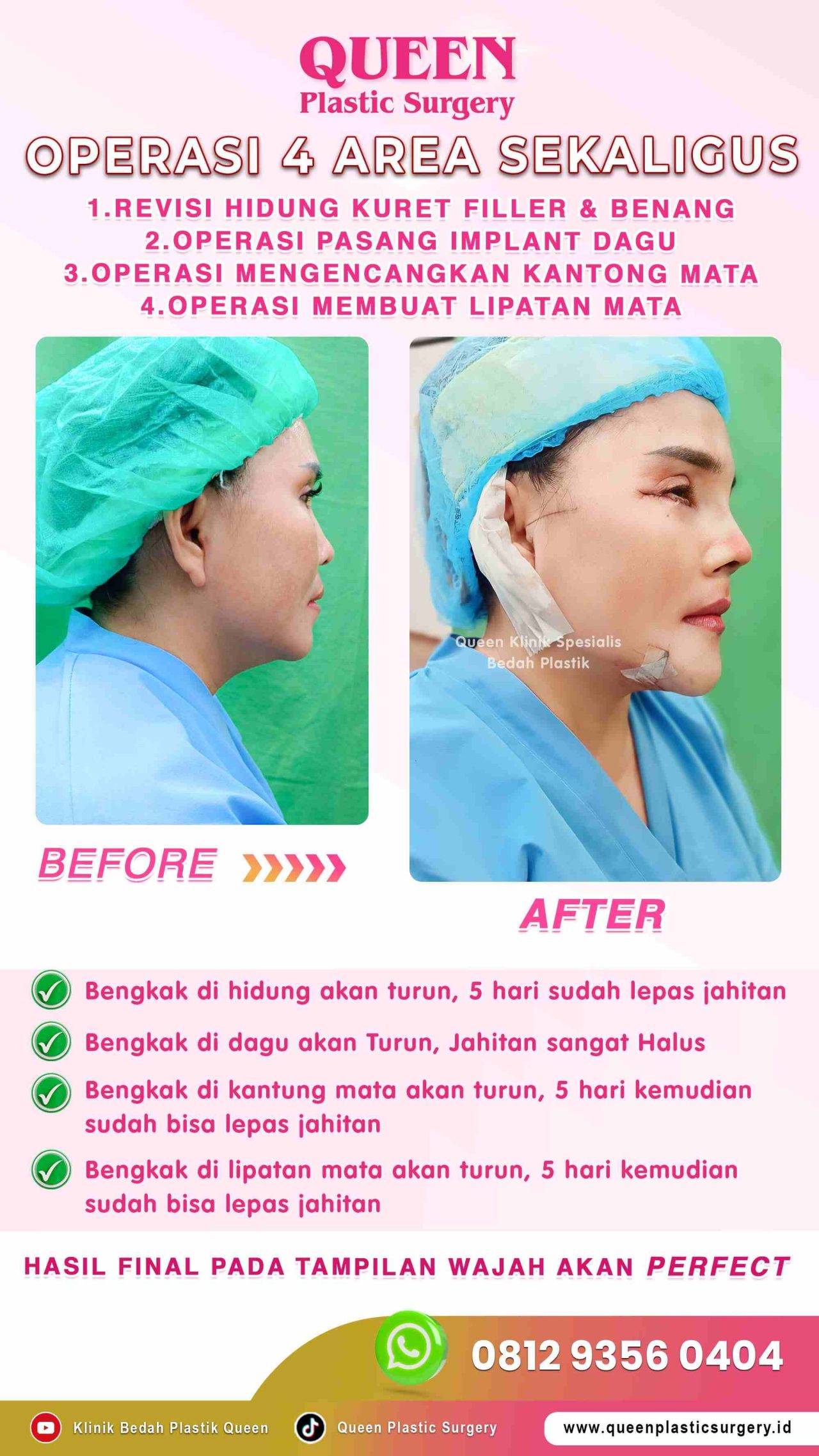 New-Operasi-4-Area-Sekaligus-Queen-IGS-001 (1)-fotor-20240129151451