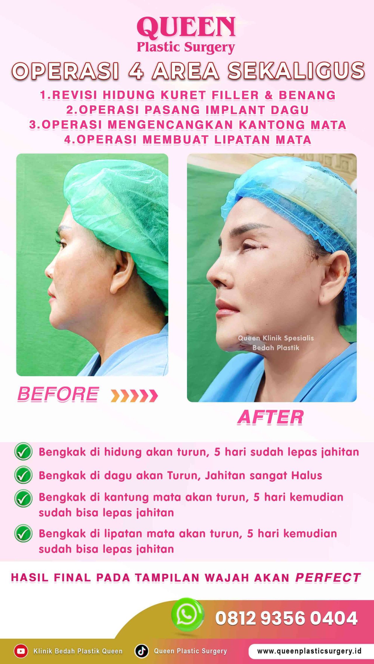 New-Operasi-4-Area-Sekaligus-Queen-IGS-002 (1)-fotor-20240129151624