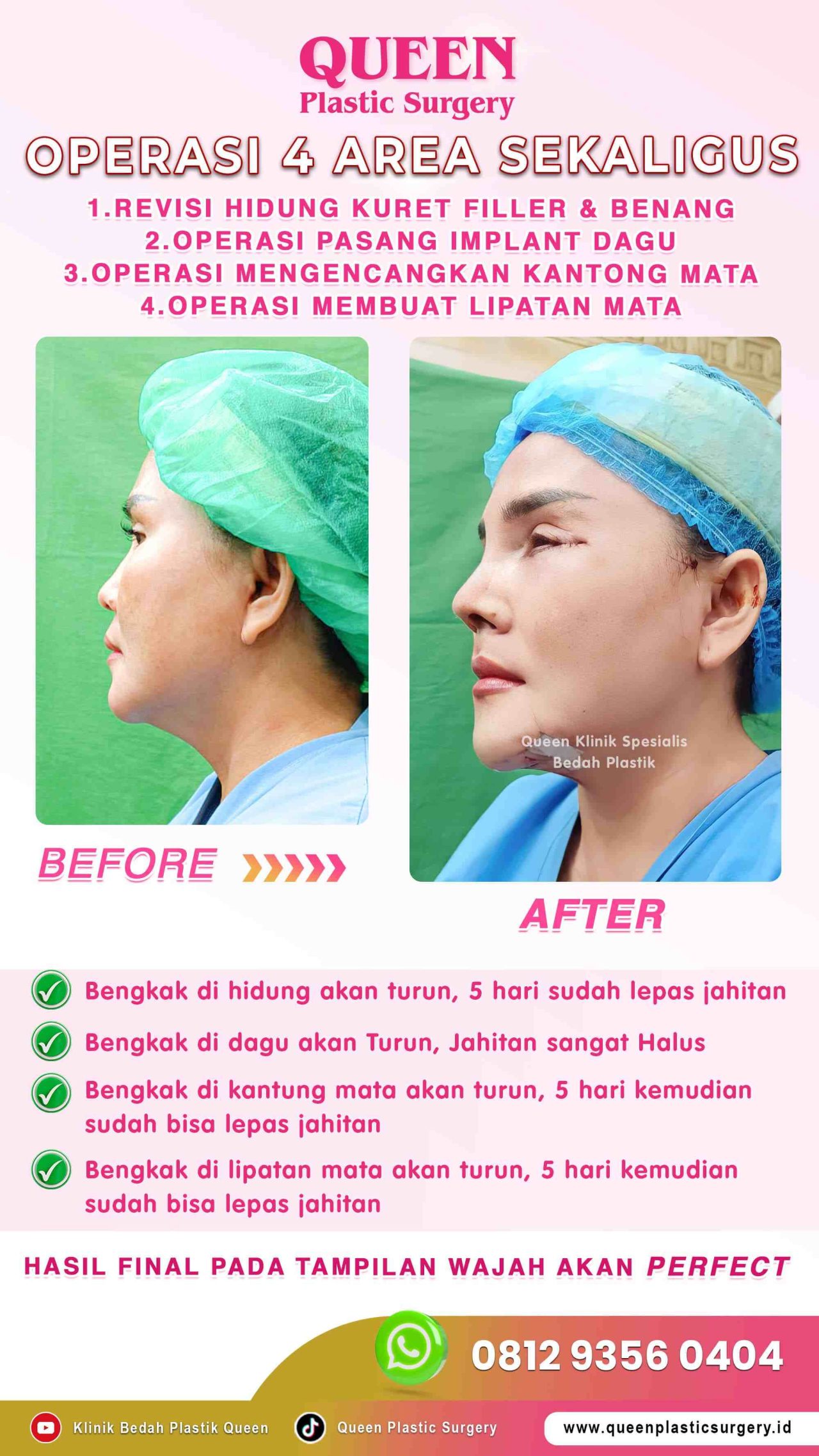 New-Operasi-4-Area-Sekaligus-Queen-IGS-002 (1)-fotor-20240130122347