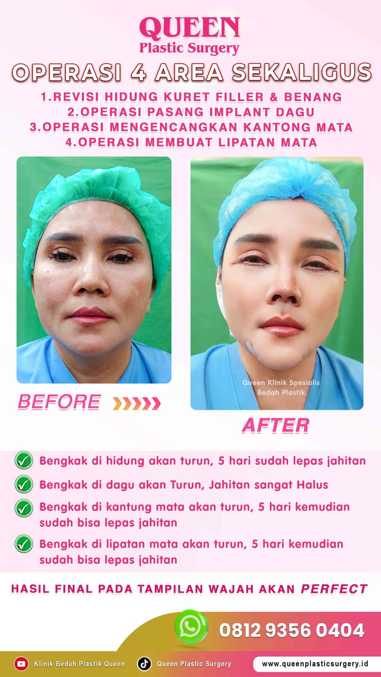 New-Operasi-4-Area-Sekaligus-Queen-IGS-003 (1)-fotor-2024012915160