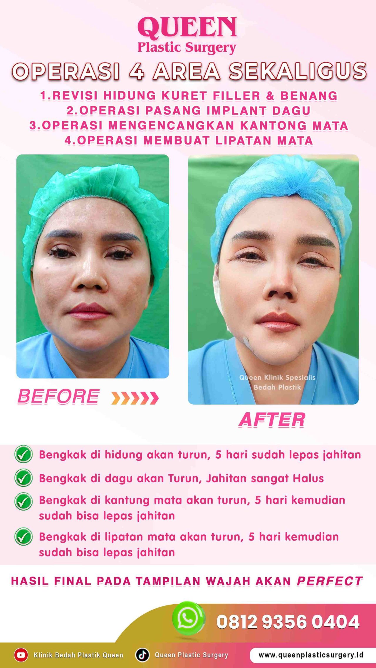 New-Operasi-4-Area-Sekaligus-Queen-IGS-003 (1)-fotor-2024013011394