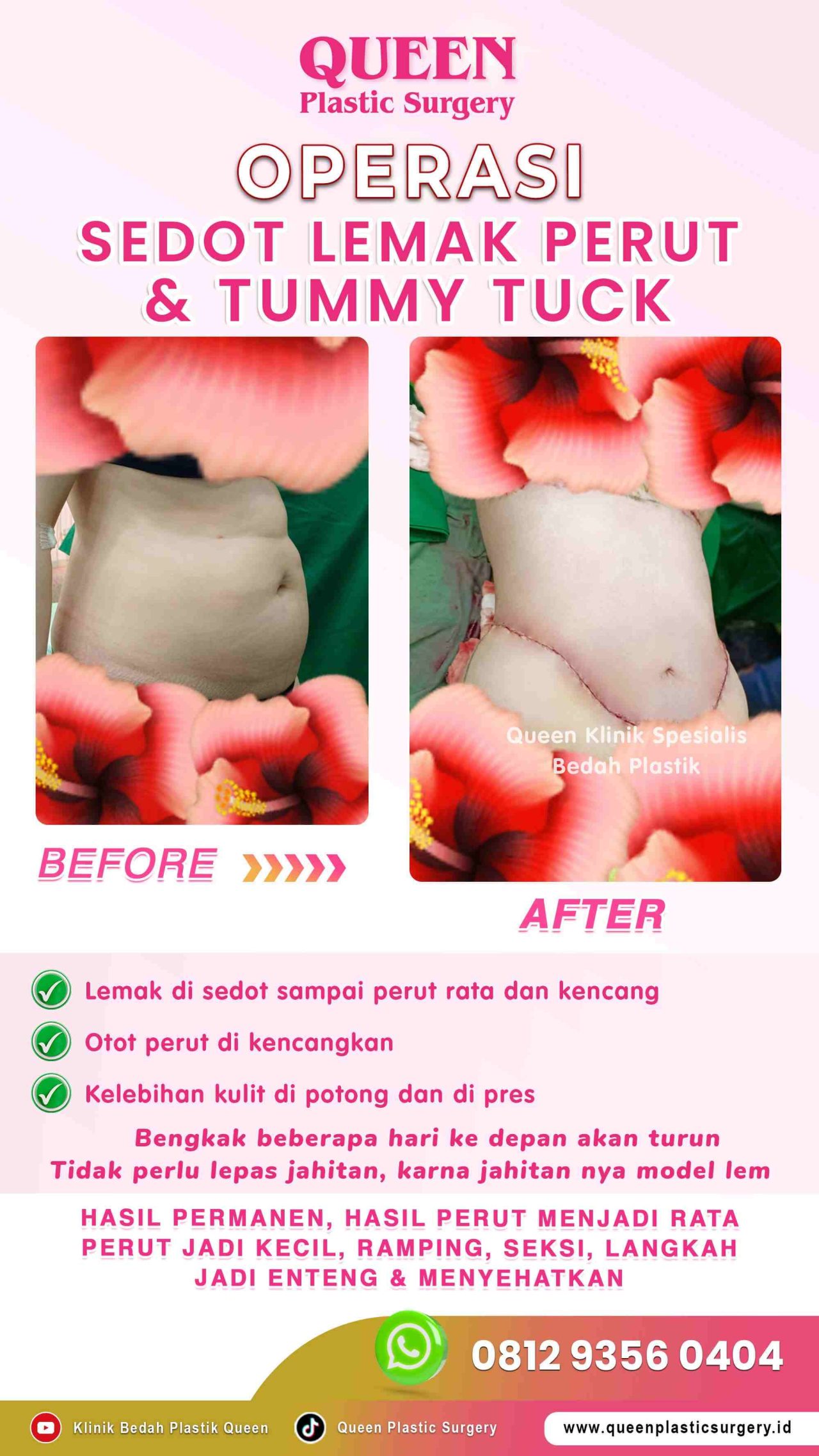 New-Operasi-Sedot-Lemak-+-Tummy-Tuck-Sept-2023-01 (1)-fotor-20240129141628