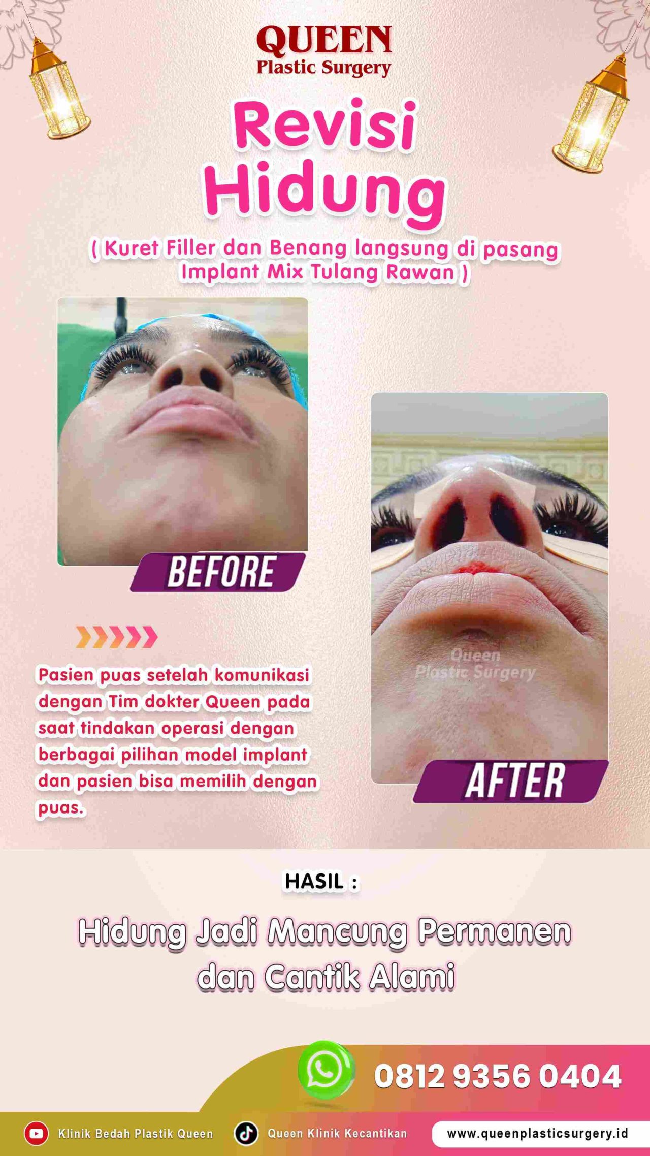 New-Revisi-Hidung-011 (1)-fotor-2024012914404