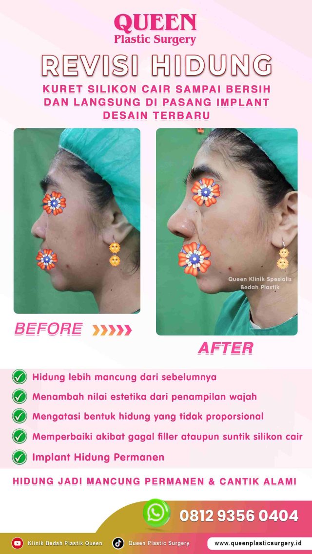 5 Langkah Penting Sebelum Operasi Revisi Hidung