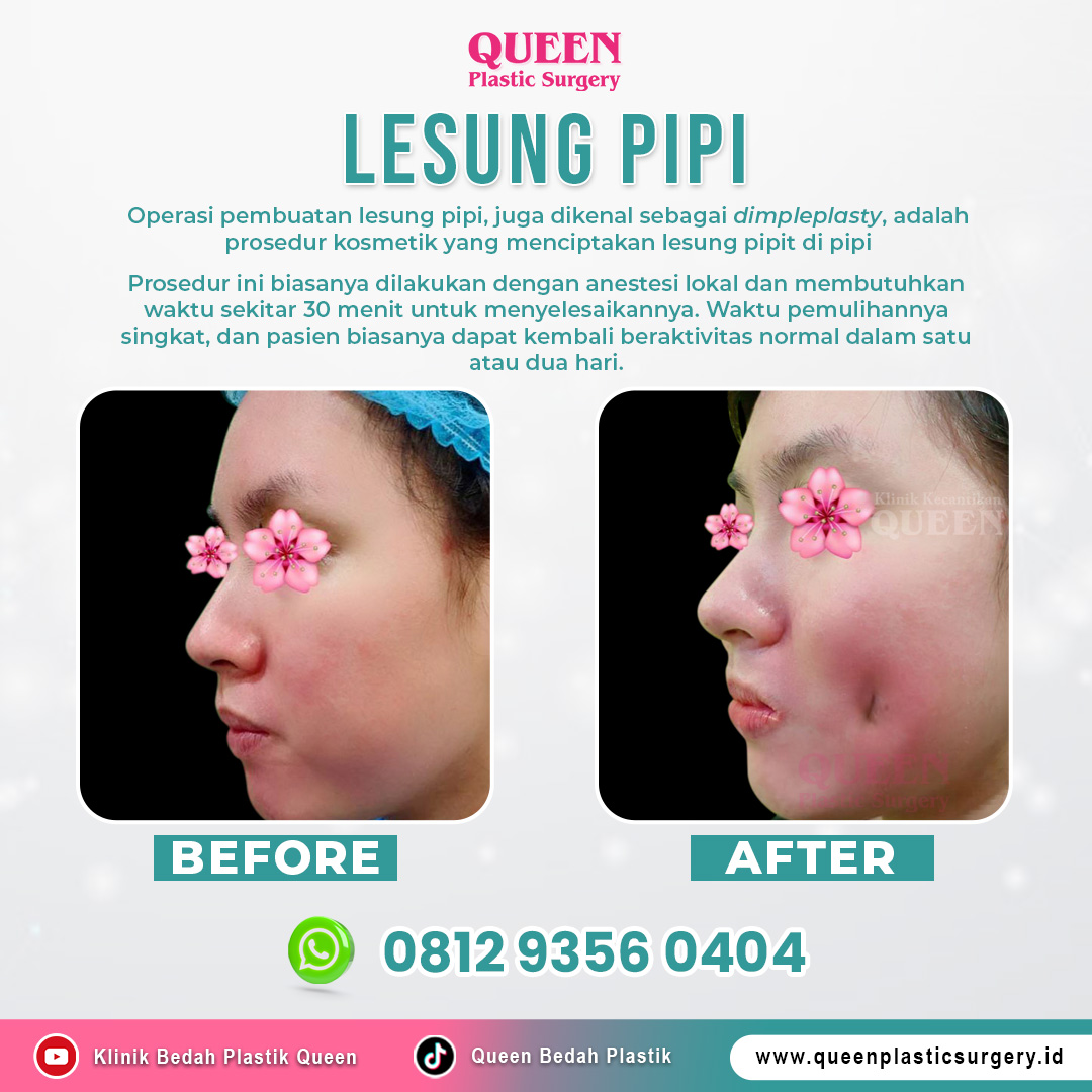 https://queenplasticsurgery.id/wp-content/uploads/2024/01/OP-Lesung-Pipi-Banner-Web.jpg
