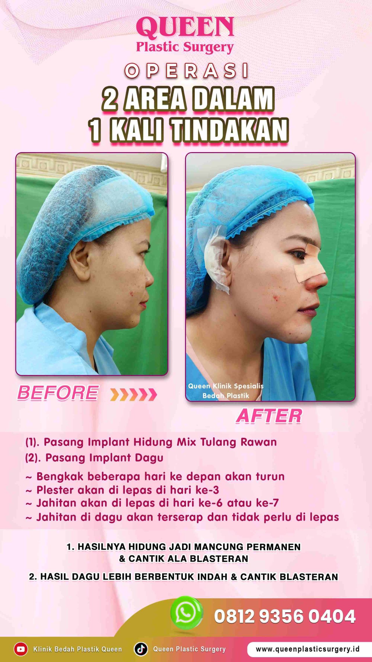 Operasi-2-Area-dalam-1x-Tindakan-Queen-001 (1)-fotor-20240129151315