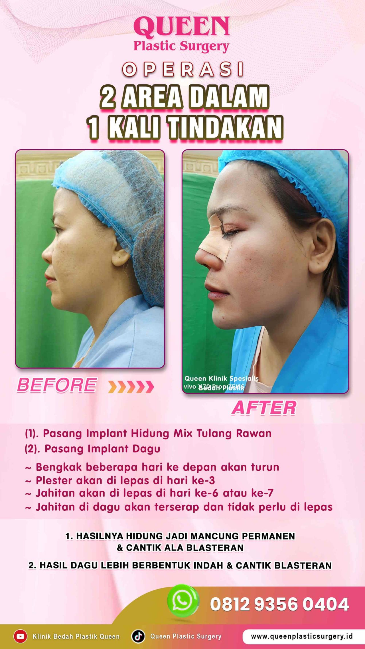 Operasi-2-Area-dalam-1x-Tindakan-Queen-002 (1)-fotor-20240129151518