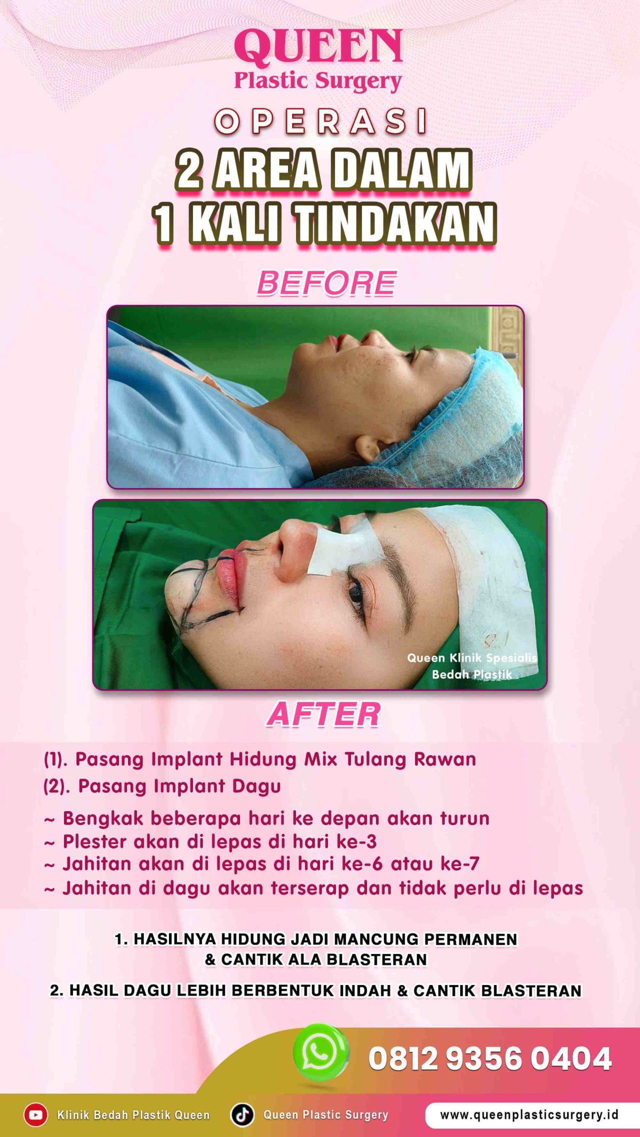 Operasi-2-Area-dalam-1x-Tindakan-Queen-003 (1)-fotor-20240129151327