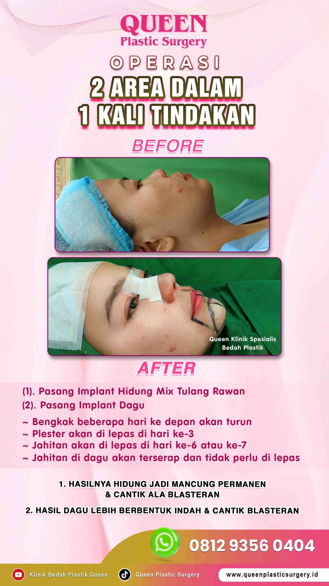 Operasi-2-Area-dalam-1x-Tindakan-Queen-004 (1)-fotor-20240129151636
