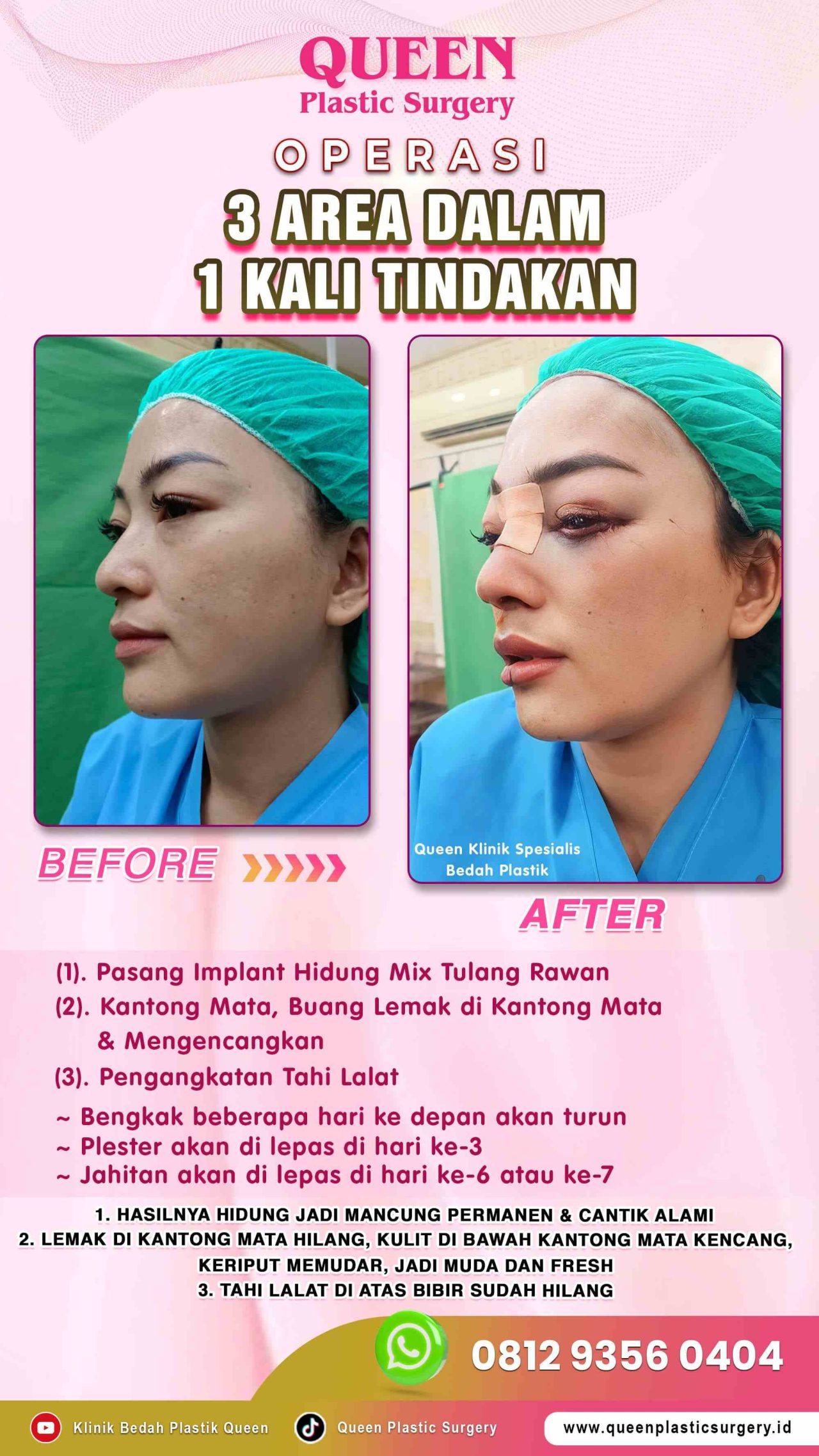 Operasi-3-Area-dalam-1x-Tindakan-Queen-002 (1)-fotor-20240130114031