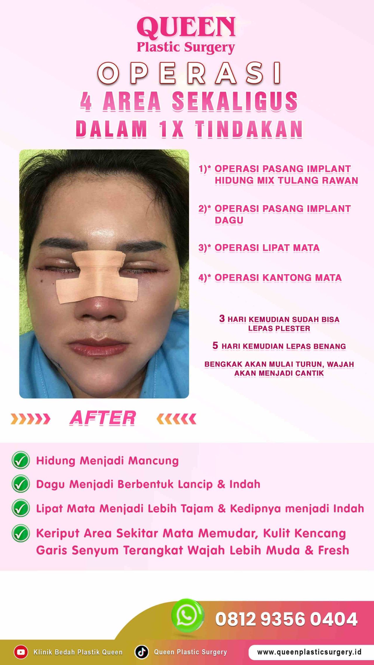 Operasi-4-Area-Sekaligus (1)-fotor-20240130114228