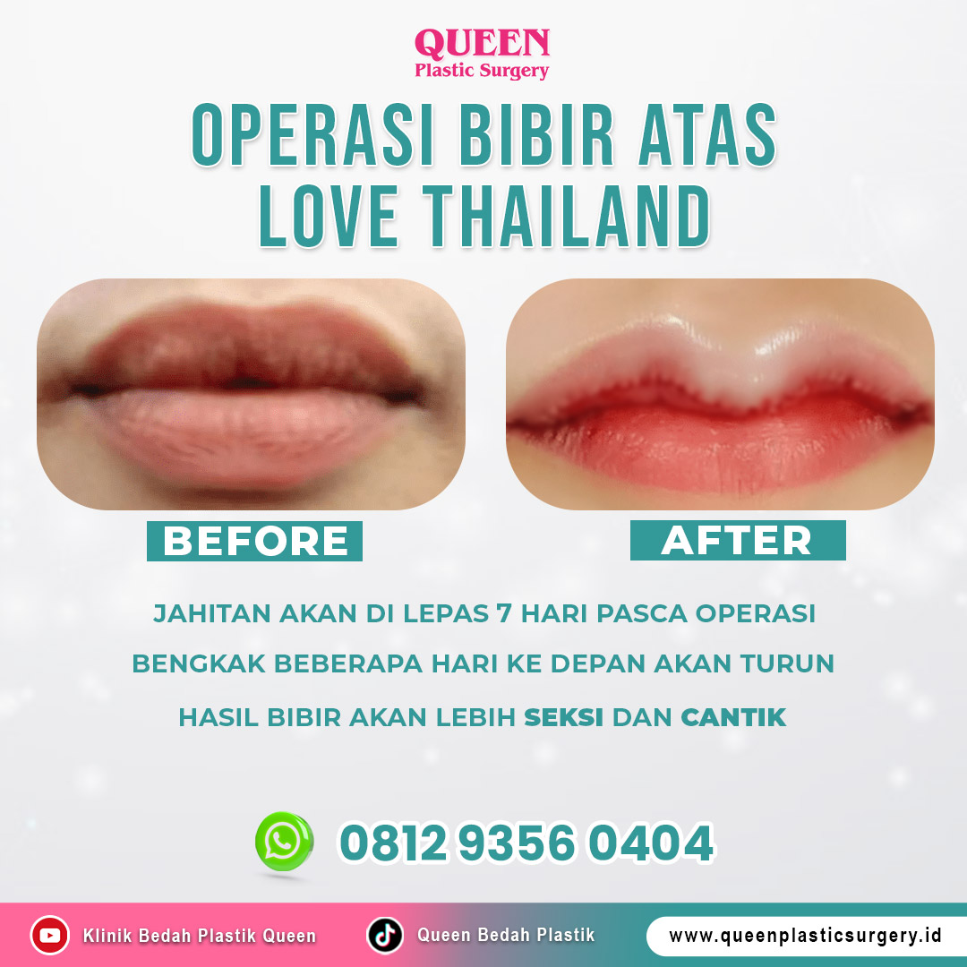 https://queenplasticsurgery.id/wp-content/uploads/2024/01/Operasi-Bibir-Atas-Love-Thailand-2.jpg