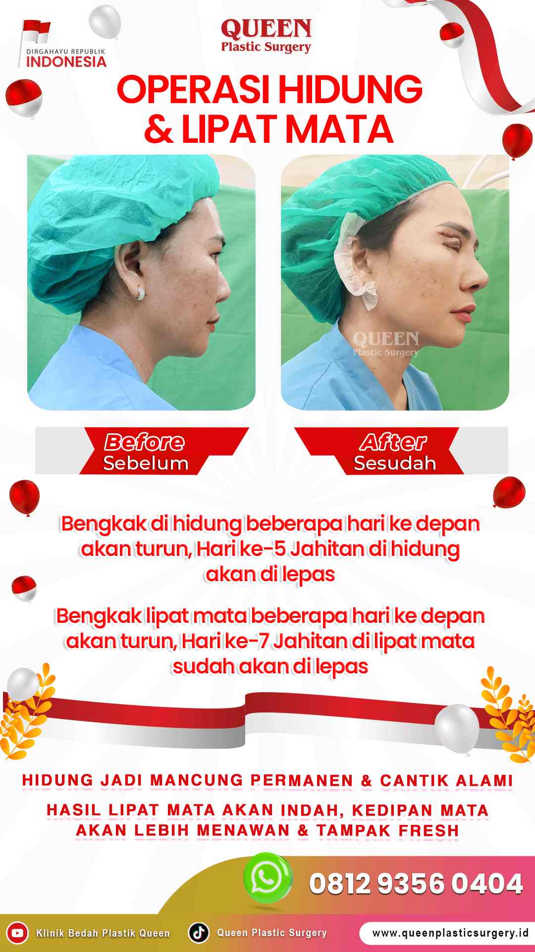 Operasi-Hidung-&-Lipat-Mata-IGS-001 (2)-fotor-2024013011475