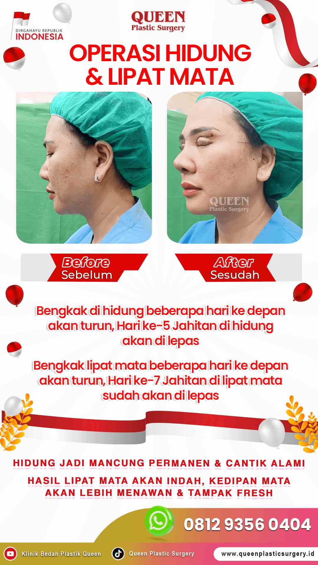 Operasi-Hidung-&-Lipat-Mata-IGS-002 (1)-fotor-20240130114737
