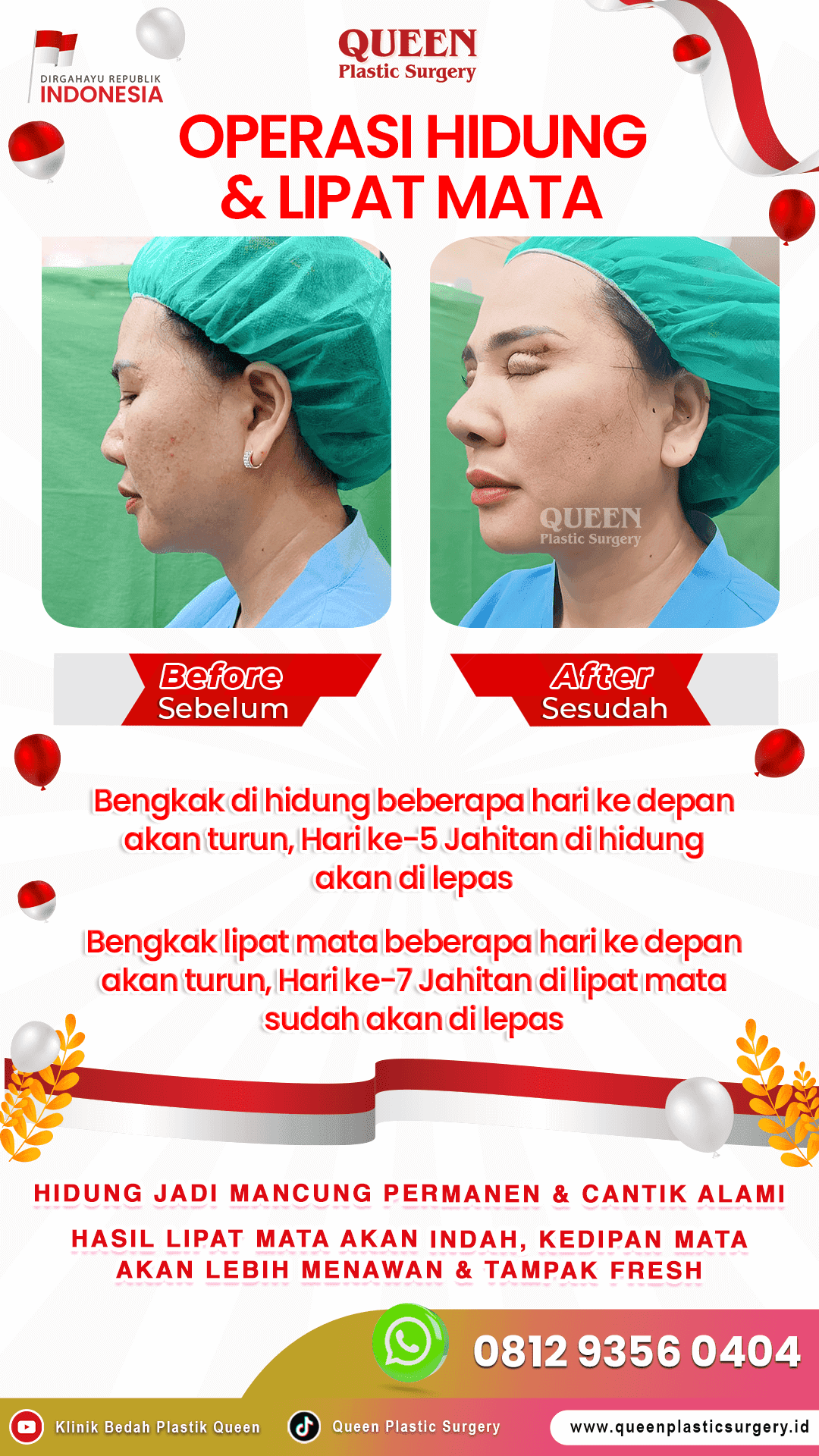 Operasi-Hidung-&-Lipat-Mata-IGS-002 (2) (1)