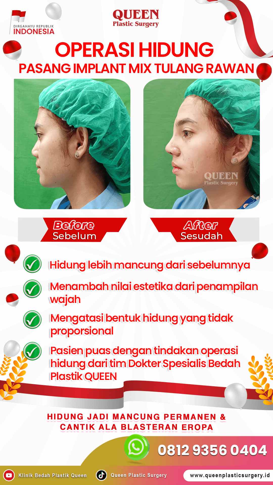 Operasi-Hidung-Mix-Tulang-Rawan-IGS-001 (1)-fotor-2024013011458