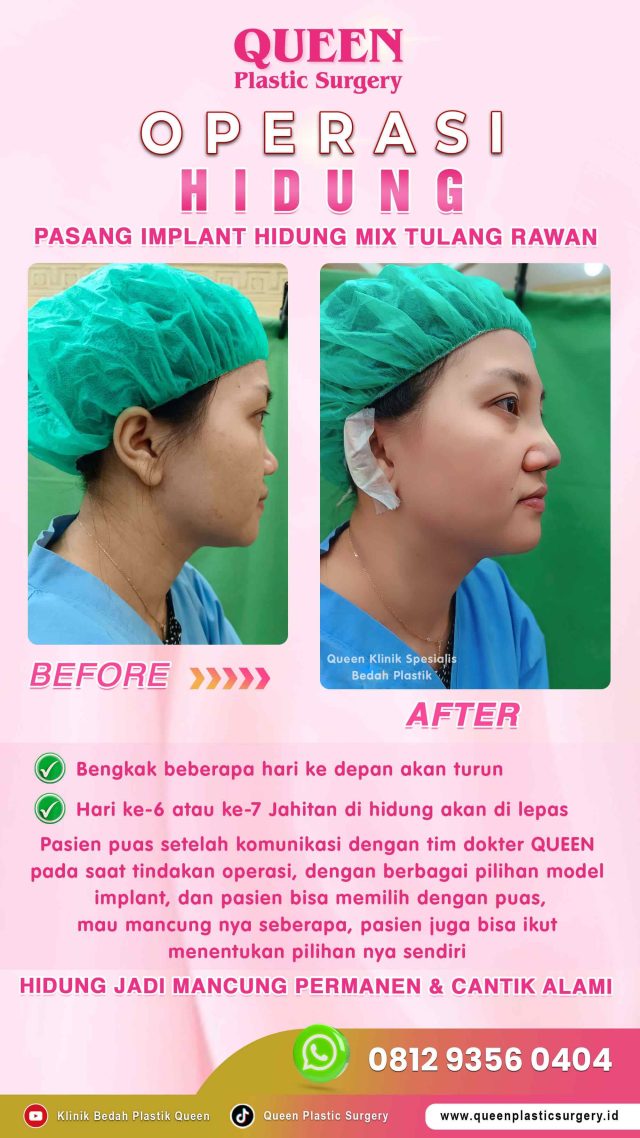 Operasi Hidung Sesuai Dengan Jenisnya di Queen Plastic Surgery