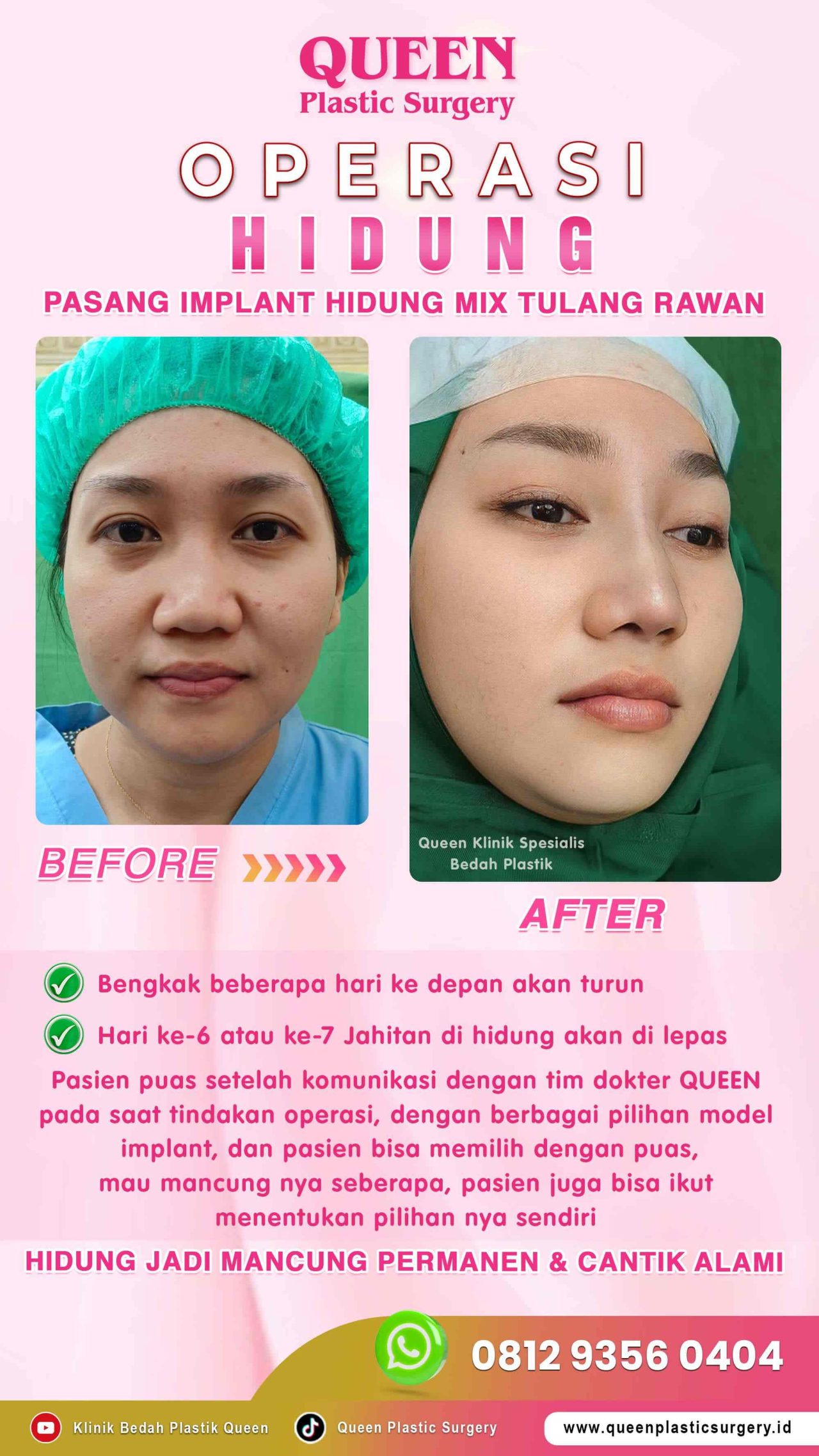 Operasi-Hidung-Queen-Surgery-Sept-003 (1)-fotor-20240130122034