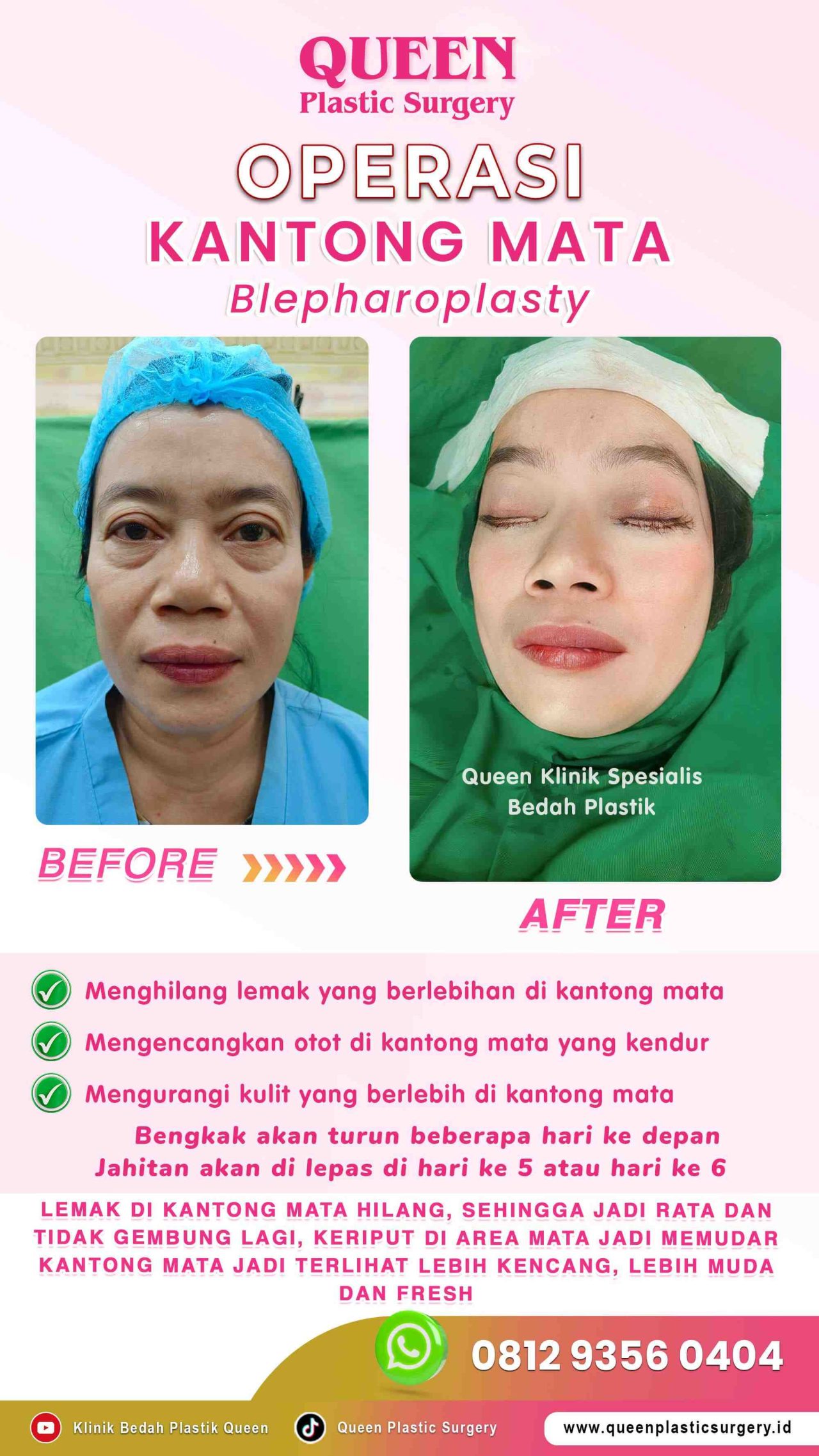 Operasi-Kantong-Mata-01 (1)-fotor-20240130114156