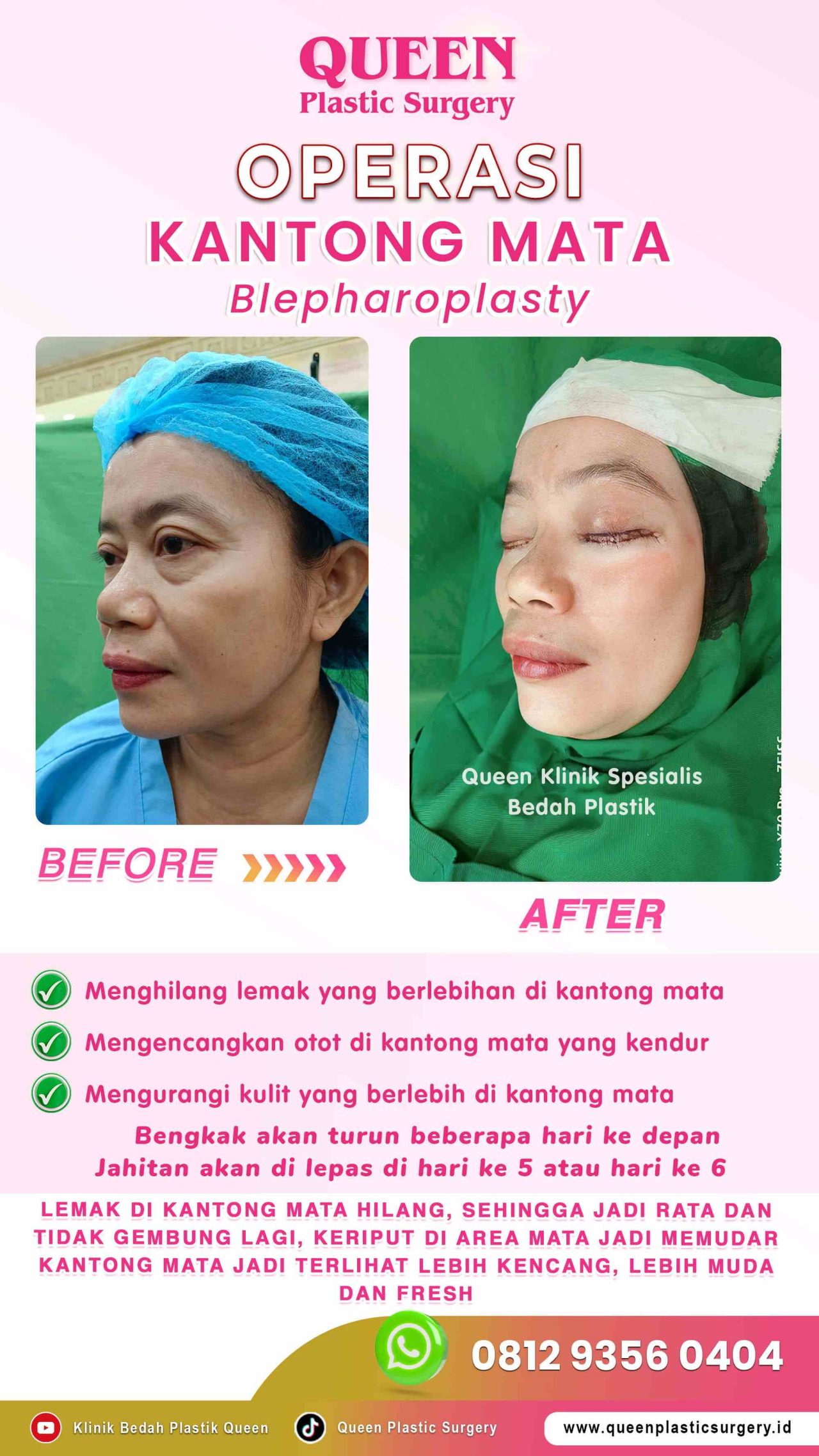 Operasi-Kantong-Mata-02 (1)-fotor-20240130114010