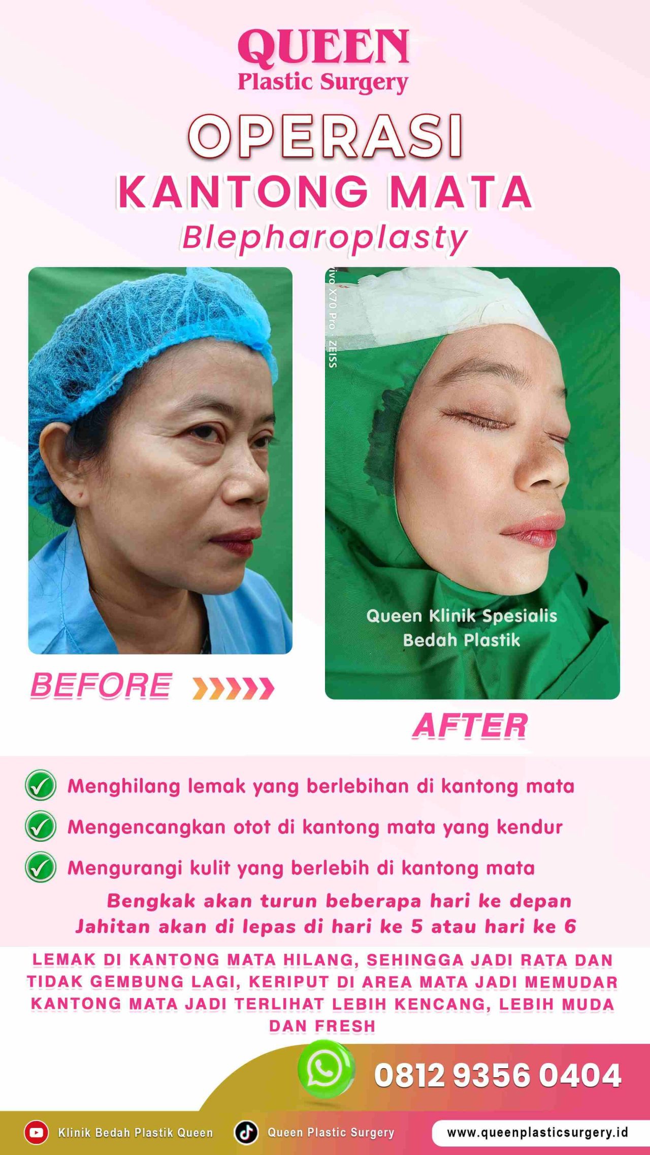 Operasi-Kantong-Mata-03 (1)-fotor-20240130113834