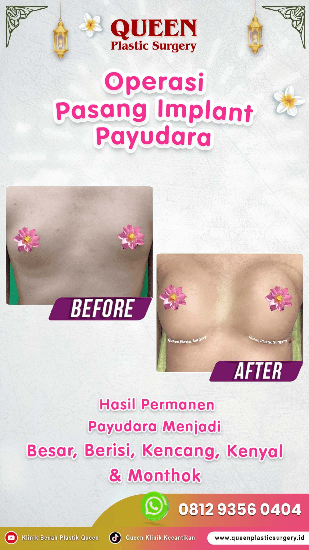 Operasi-Pasang-Implant-Payudara-002 (1)-fotor-20240129161039