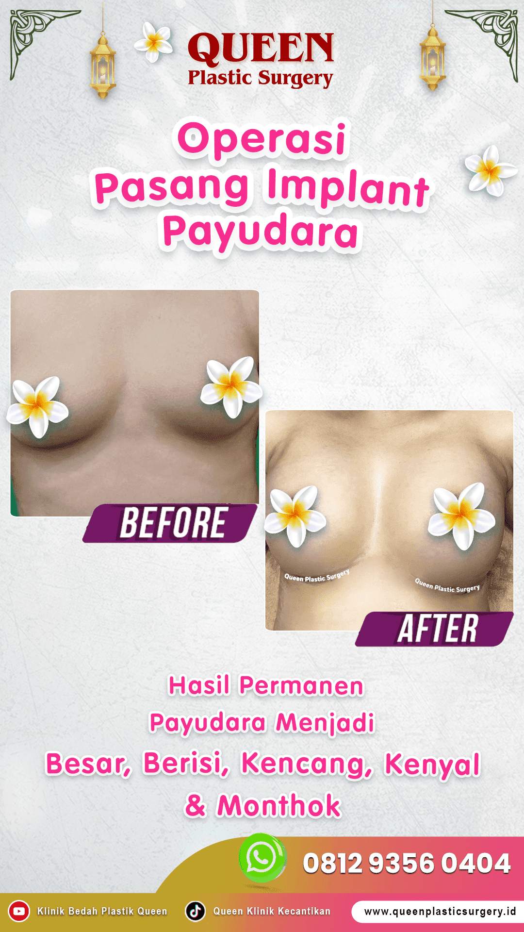 Operasi-Pasang-Implant-Payudara (1)-fotor-20240129161052