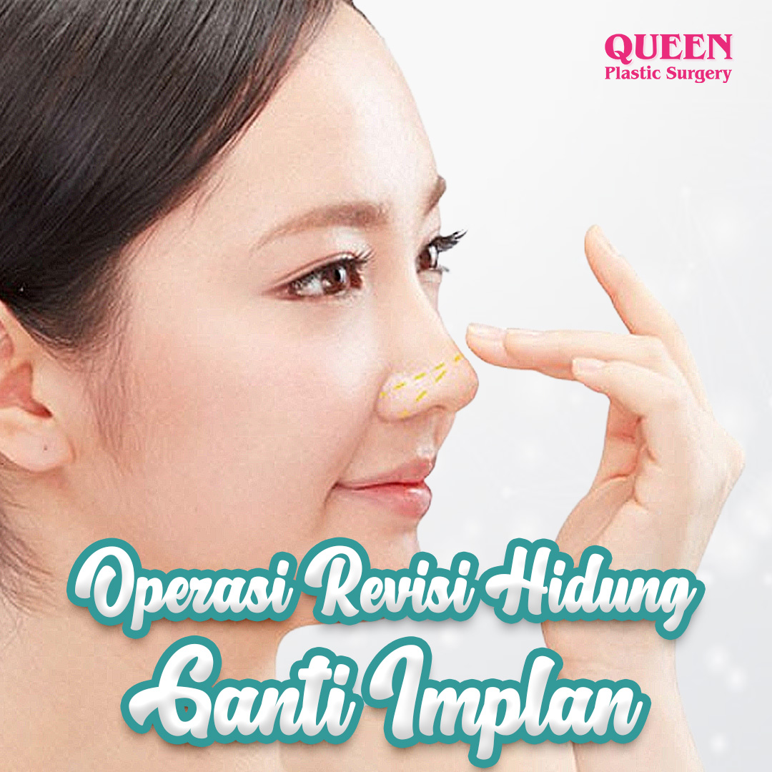https://queenplasticsurgery.id/wp-content/uploads/2024/01/Operasi-Revisi-Hidung-Ganti-Implan.jpg
