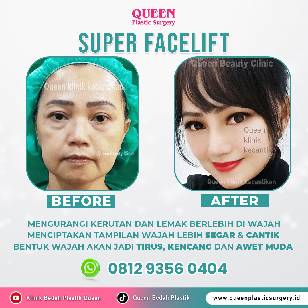 https://queenplasticsurgery.id/wp-content/uploads/2024/01/Redesign-Super-Facelift-Pasien-Queen-Web-2.jpg