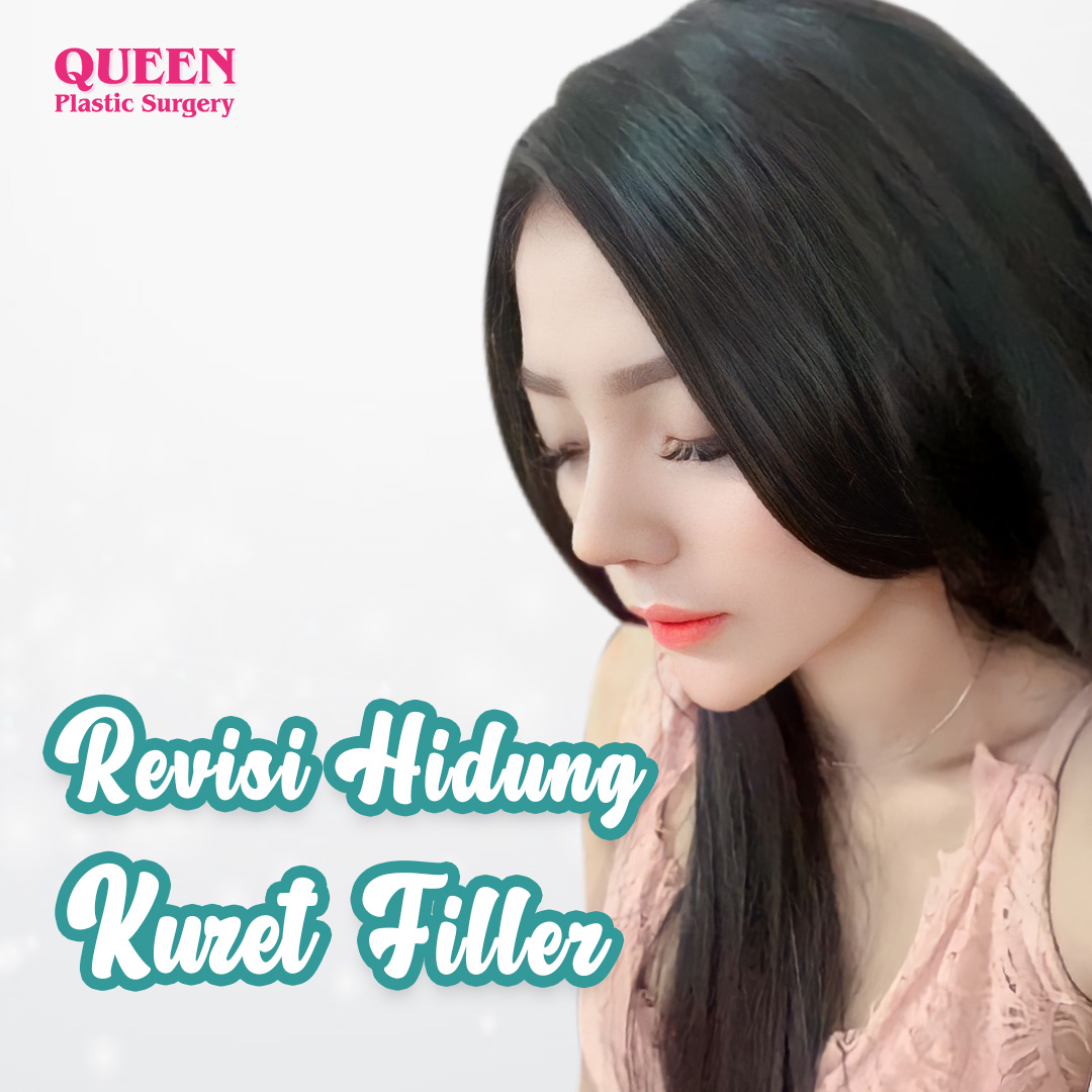 https://queenplasticsurgery.id/wp-content/uploads/2024/01/Revisi-Hidung-Kuret-Filler.jpg