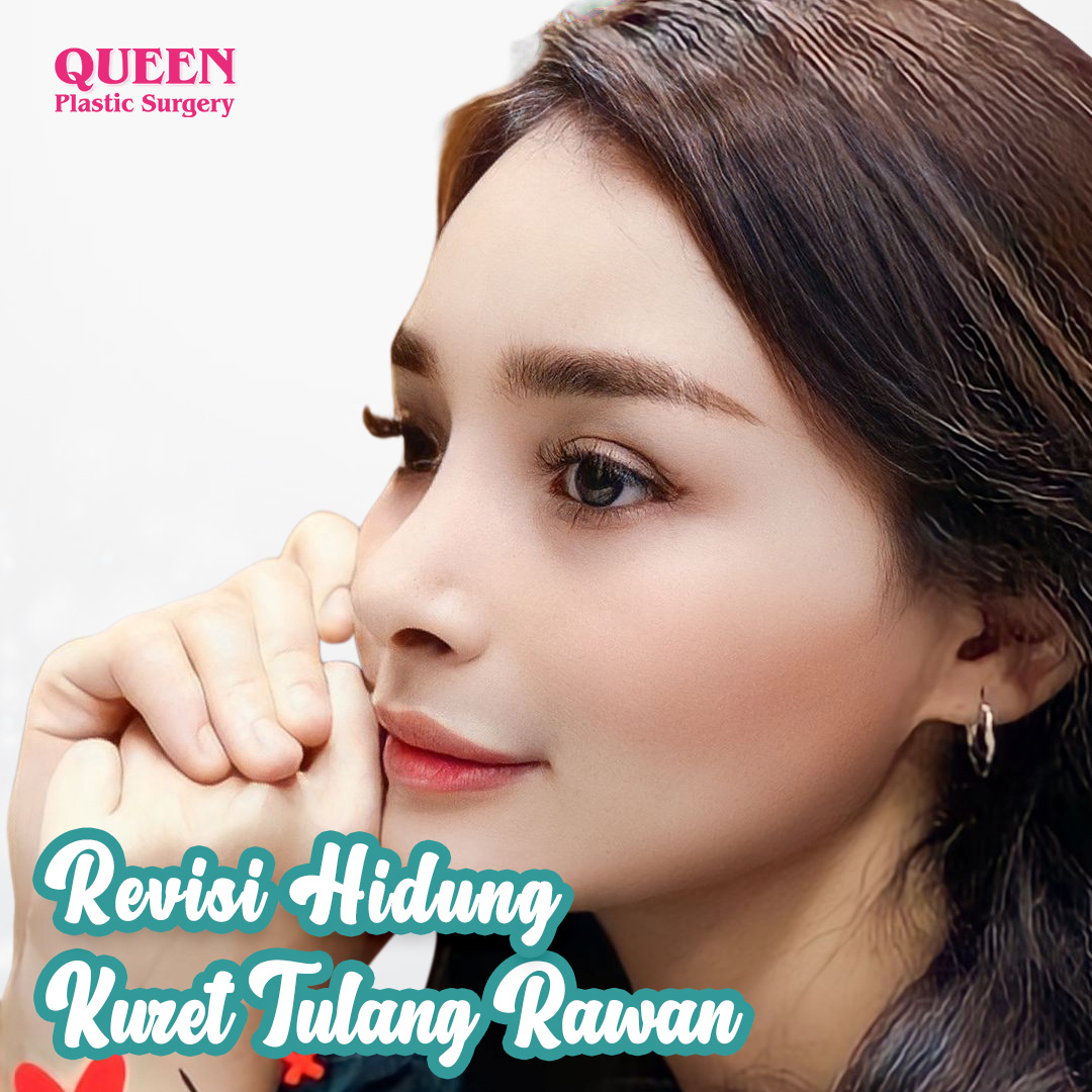 https://queenplasticsurgery.id/wp-content/uploads/2024/01/Revisi-Hidung-Kuret-Tulang-Rawan-1.jpg