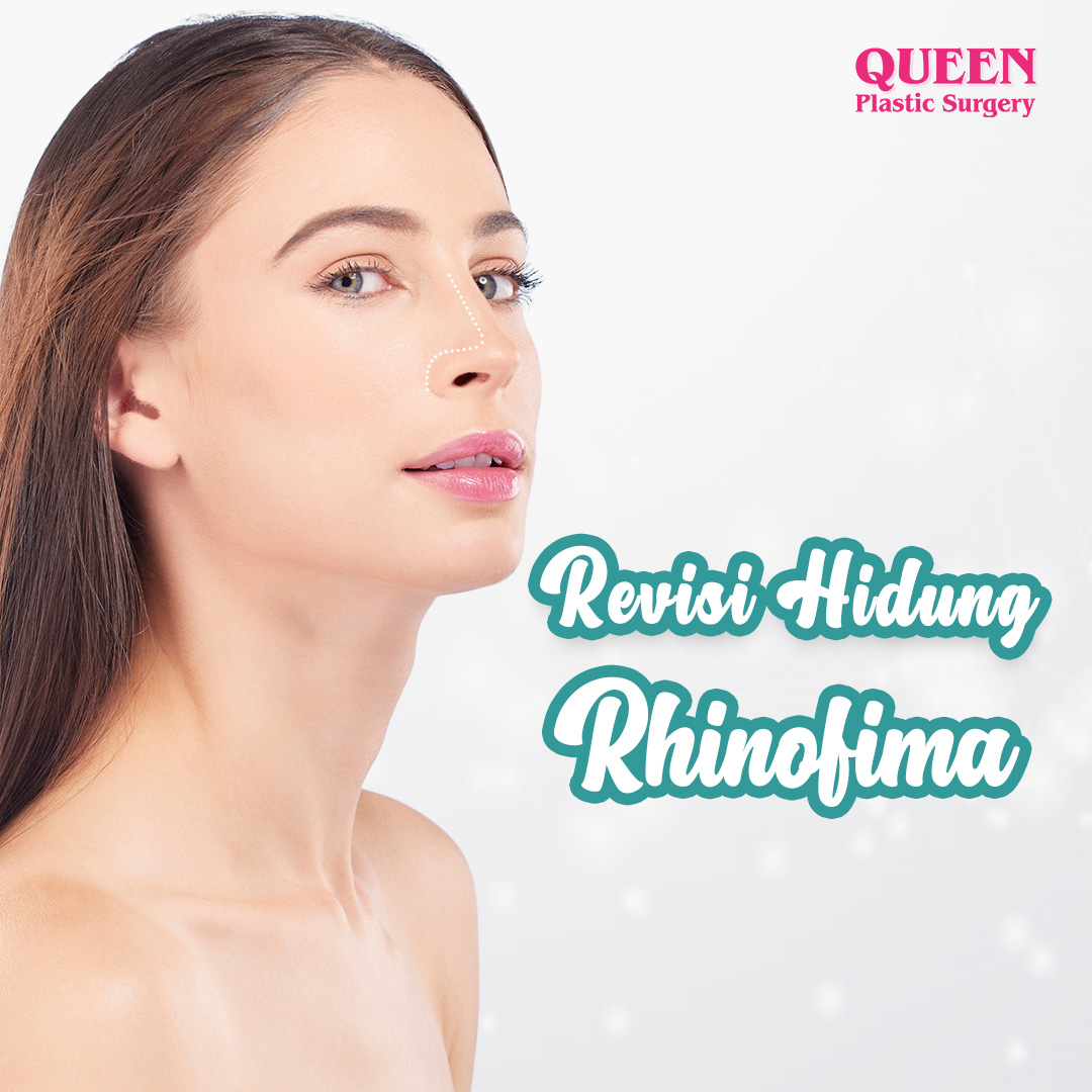 https://queenplasticsurgery.id/wp-content/uploads/2024/01/Revisi-Hidung-Rhinofima.jpg