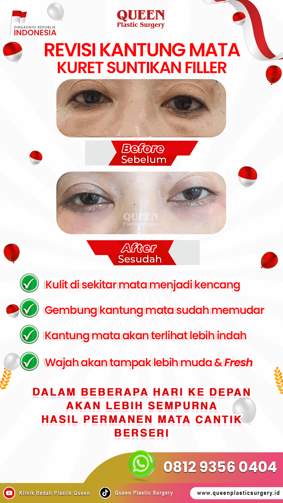 Revisi-Kantung-Mata-Queen-IGS (1)