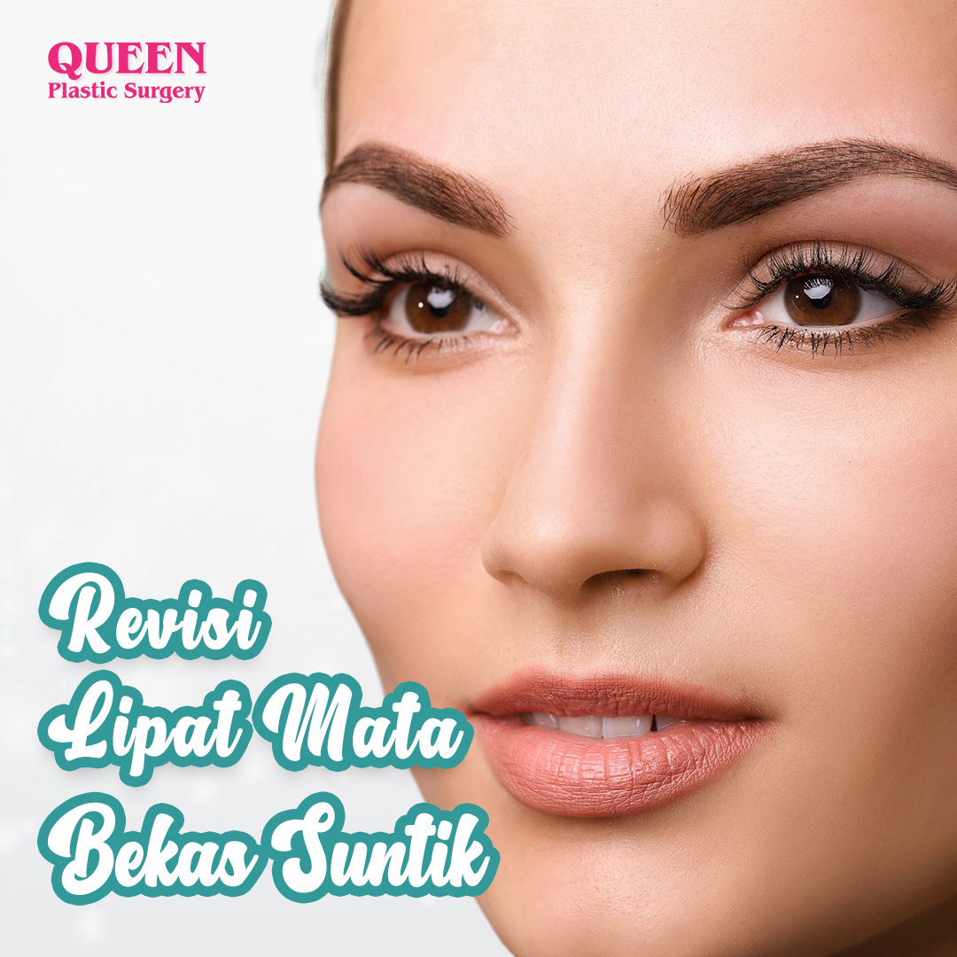 https://queenplasticsurgery.id/wp-content/uploads/2024/01/Revisi-Lipat-Mata-Bekas-Suntik-Web.jpg