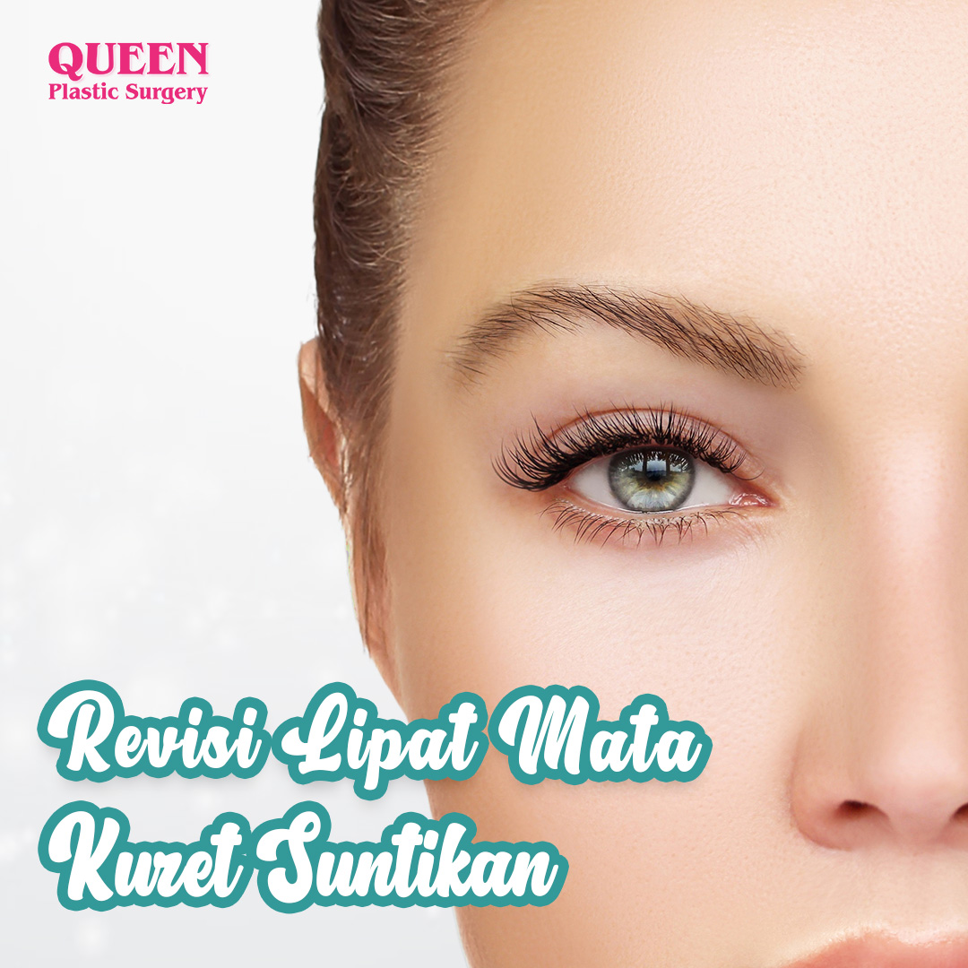 https://queenplasticsurgery.id/wp-content/uploads/2024/01/Revisi-Lipat-Mata-Kuret-Suntikan-Web.jpg